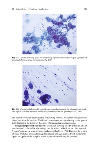 31911 Cytopathology of Head and Neck Lesions
Fig. 11.2 A normal salivary gland was incidentally aspirated to reveal ball-shaped aggregates of
acinar cells forming grape-like structures. Pap 200×
Fig. 11.3 Chronic sialadenitis (44 year old man with enlargement of the submandibular gland).
The aspirate contained a reduced number of acinar cells with some lymphocytes. DQ 200×
and scar tissue keeps replacing the functioning lobules, the acinar cells gradually
disappear from the aspirate. Mucinous or squamous metaplasia may occur, poten-
tially leading to the incorrect diagnosis of mucoepidermoid carcinoma.
Benign lymphoepithelial lesions, which can develop in HIV infection and in
autoimmune sialadenitis (including the localized Mikulicz’s or the systemic
Sjogren’s disease) also yield numerous lymphoid cells on FNA. Ductal cells, groups
of basal epithelial cells and myoepithelial cells are seen admixed with the lympho-
cytes, and, prior to the atrophic phase, some acinar cells are also present.
 