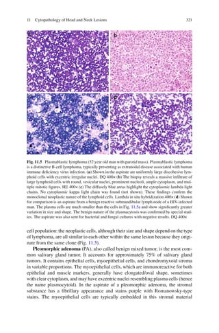 32111 Cytopathology of Head and Neck Lesions
cell population: the neoplastic cells, although their size and shape depend on the type
of lymphoma, are all similar to each other within the same lesion because they origi-
nate from the same clone (Fig. 11.5).
Pleomorphic adenoma (PA), also called benign mixed tumor, is the most com-
mon salivary gland tumor. It accounts for approximately 75% of salivary gland
tumors. It contains epithelial cells, myoepithelial cells, and chondromyxoid stroma
in variable proportions. The myoepithelial cells, which are immunoreactive for both
epithelial and muscle markers, generally have elongated/oval shape, sometimes
with clear cytoplasm, and may have excentric nuclei resembling plasma cells (hence
the name plasmocytoid). In the aspirate of a pleomorphic adenoma, the stromal
substance has a ﬁbrillary appearance and stains purple with Romanowsky-type
stains. The myoepithelial cells are typically embedded in this stromal material
Fig. 11.5 Plasmablastic lymphoma (52 year old man with parotid mass). Plasmablastic lymphoma
is a distinctive B-cell lymphoma, typically presenting as extranodal disease associated with human
immune deﬁciency virus infection. (a) Shown in the aspirate are uniformly large discohesive lym-
phoid cells with excentric irregular nuclei. DQ 400× (b) The biopsy reveals a massive inﬁltrate of
large lymphoid cells with round, vesicular nuclei, prominent nucleoli, ample cytoplasm, and mul-
tiple mitotic ﬁgures. HE 400× (c) The diffusely blue areas highlight the cytoplasmic lambda light
chains. No cytoplasmic kappa light chain was found (not shown). These ﬁndings conﬁrm the
monoclonal neoplastic nature of the lymphoid cells. Lambda in situ hybridization 400× (d) Shown
for comparison is an aspirate from a benign reactive submandibular lymph node of a HIV-infected
man. The plasma cells are much smaller than the cells in Fig. 11.5a and show signiﬁcantly greater
variation in size and shape. The benign nature of the plasmacytosis was conﬁrmed by special stud-
ies. The aspirate was also sent for bacterial and fungal cultures with negative results. DQ 400×
 