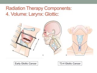 Radiation Therapy Components:
4. Volume: Larynx: Glottic:
Early Glottic Cancer T3-4 Glottic Cancer
 