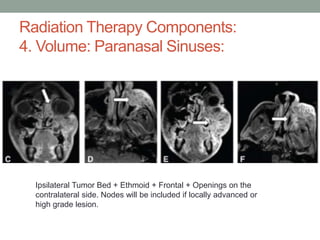 Radiation Therapy Components:
4. Volume: Paranasal Sinuses:
Ipsilateral Tumor Bed + Ethmoid + Frontal + Openings on the
contralateral side. Nodes will be included if locally advanced or
high grade lesion.
 
