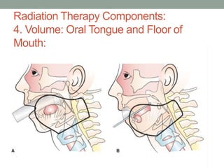 Radiation Therapy Components:
4. Volume: Oral Tongue and Floor of
Mouth:
 