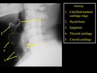 Tracheal Rings Radiopaedia head & Neck Radiology .ppt MBBS lecture 1 | PPT