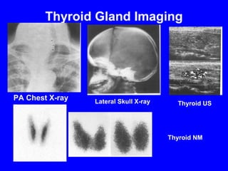 Thyroid Gland Imaging




PA Chest X-ray   Lateral Skull X-ray     Thyroid US




                                       Thyroid NM
 