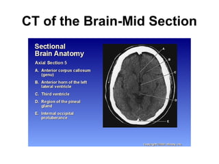 CT of the Brain-Mid Section
 