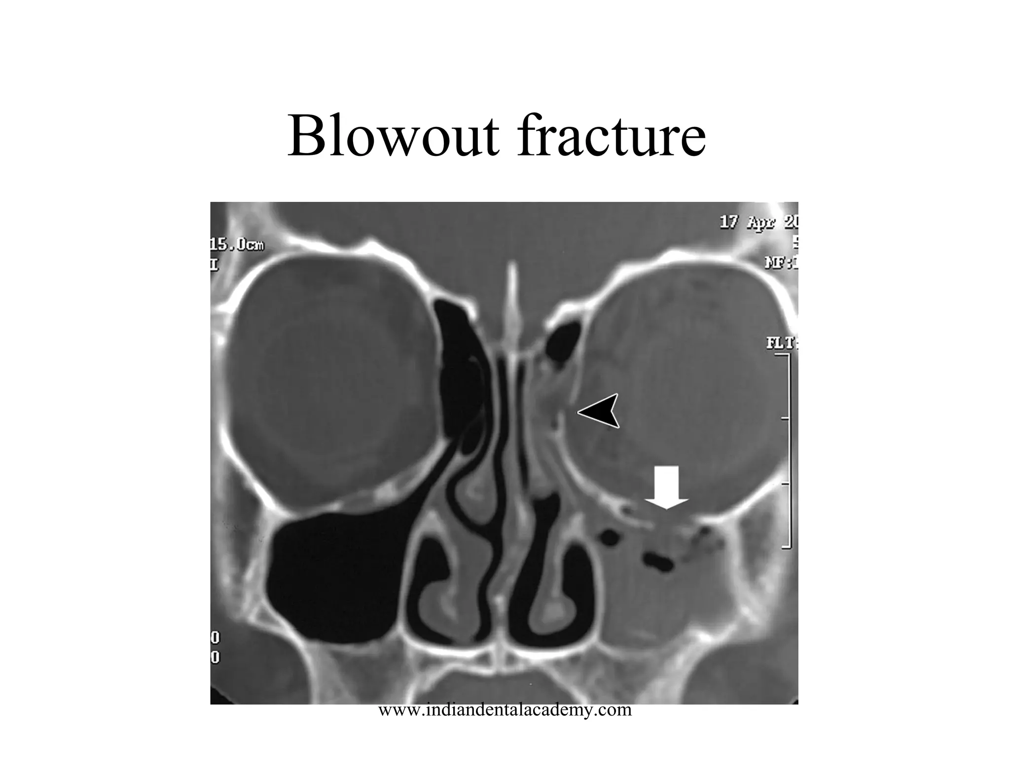 Blowout fracture

www.indiandentalacademy.com

 