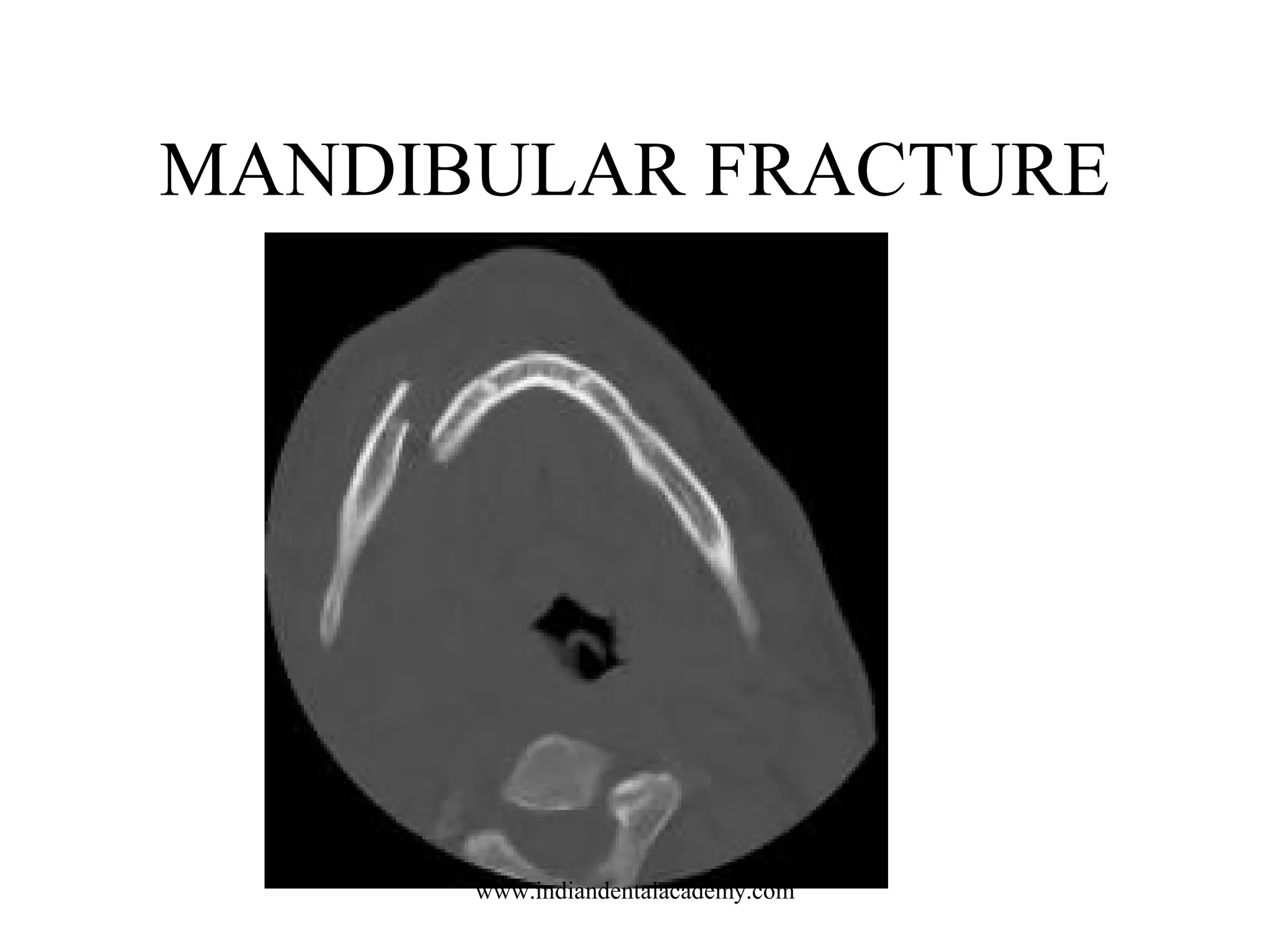MANDIBULAR FRACTURE

www.indiandentalacademy.com

 