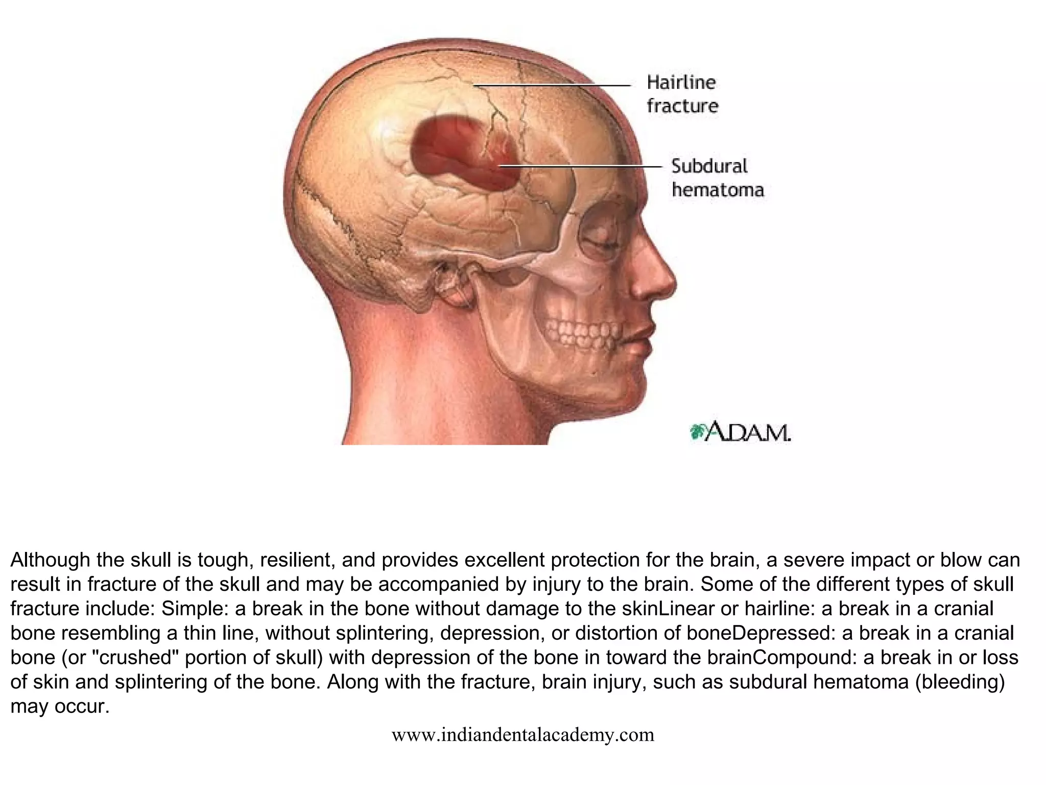 Although the skull is tough, resilient, and provides excellent protection for the brain, a severe impact or blow can
result in fracture of the skull and may be accompanied by injury to the brain. Some of the different types of skull
fracture include: Simple: a break in the bone without damage to the skinLinear or hairline: a break in a cranial
bone resembling a thin line, without splintering, depression, or distortion of boneDepressed: a break in a cranial
bone (or "crushed" portion of skull) with depression of the bone in toward the brainCompound: a break in or loss
of skin and splintering of the bone. Along with the fracture, brain injury, such as subdural hematoma (bleeding)
may occur.
www.indiandentalacademy.com

 