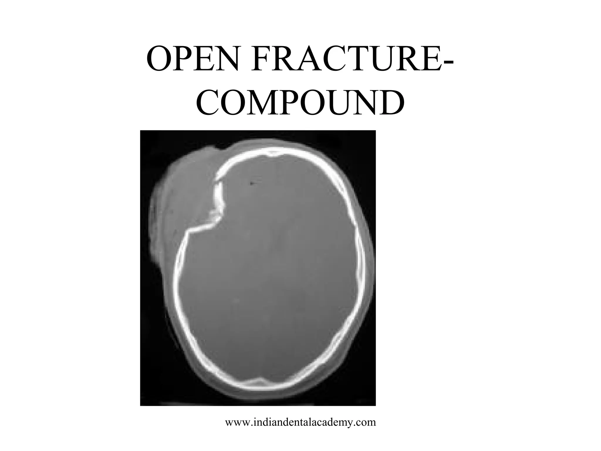 OPEN FRACTURECOMPOUND

www.indiandentalacademy.com

 