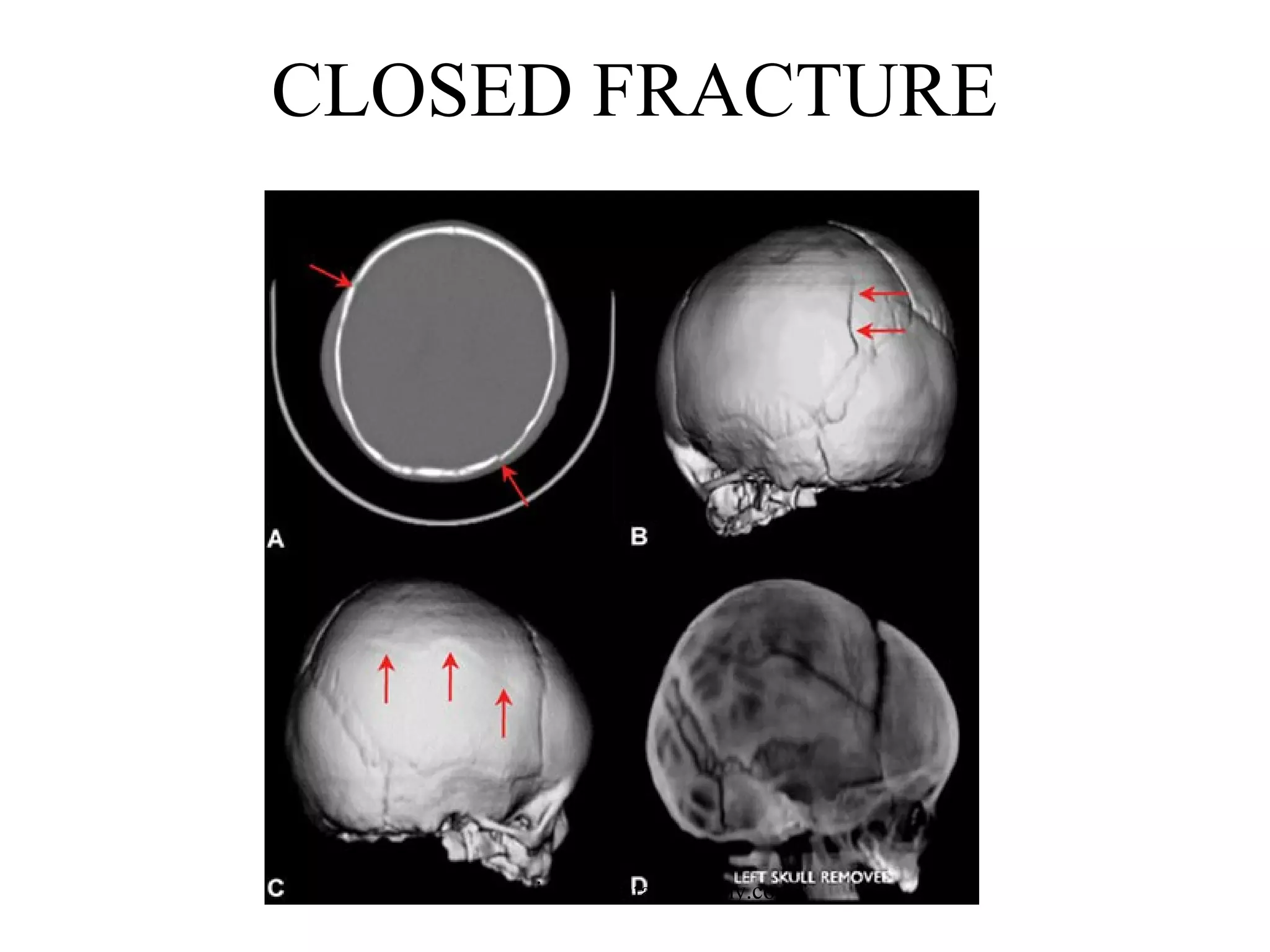 CLOSED FRACTURE

www.indiandentalacademy.com

 