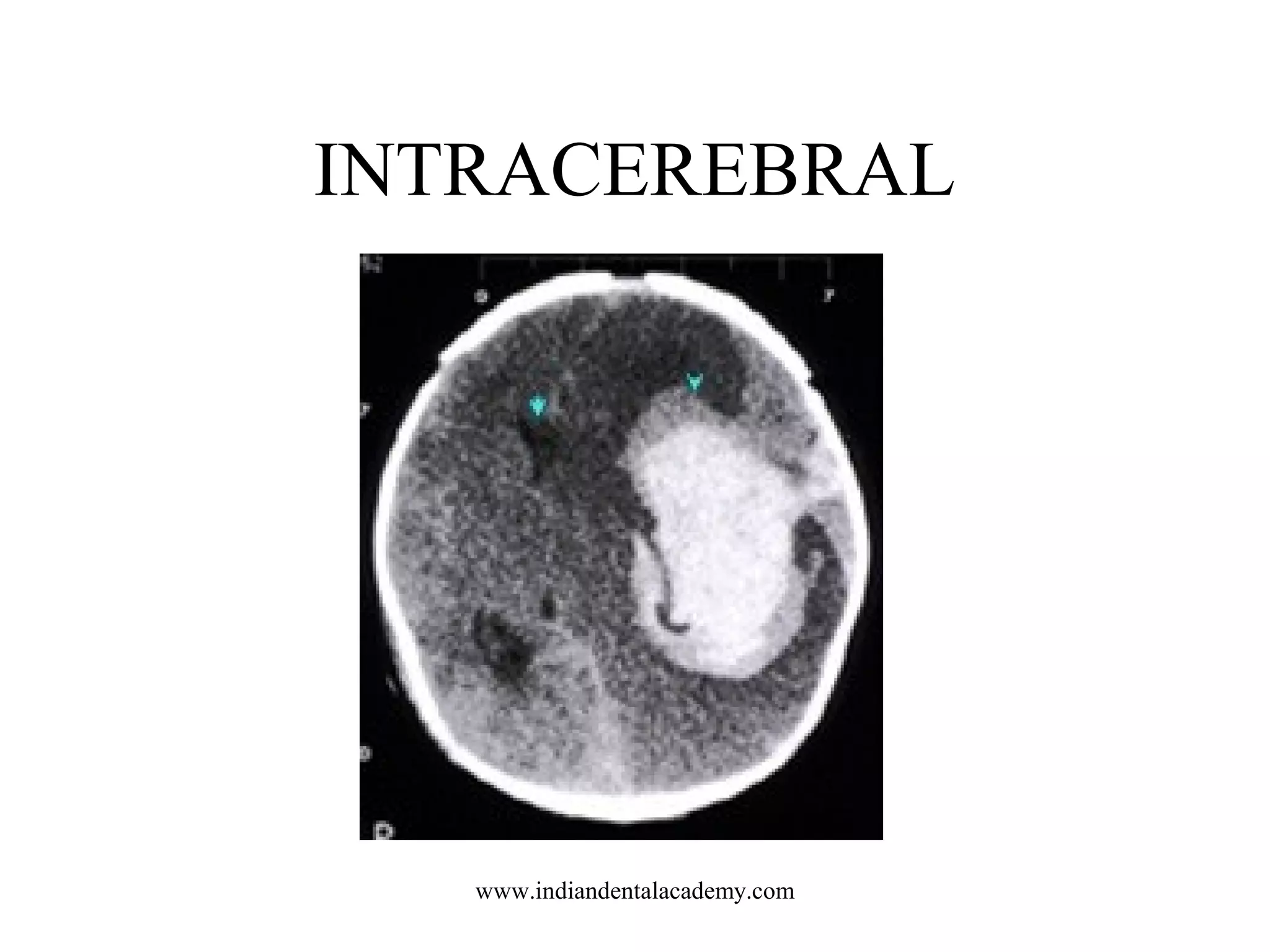 INTRACEREBRAL

www.indiandentalacademy.com

 