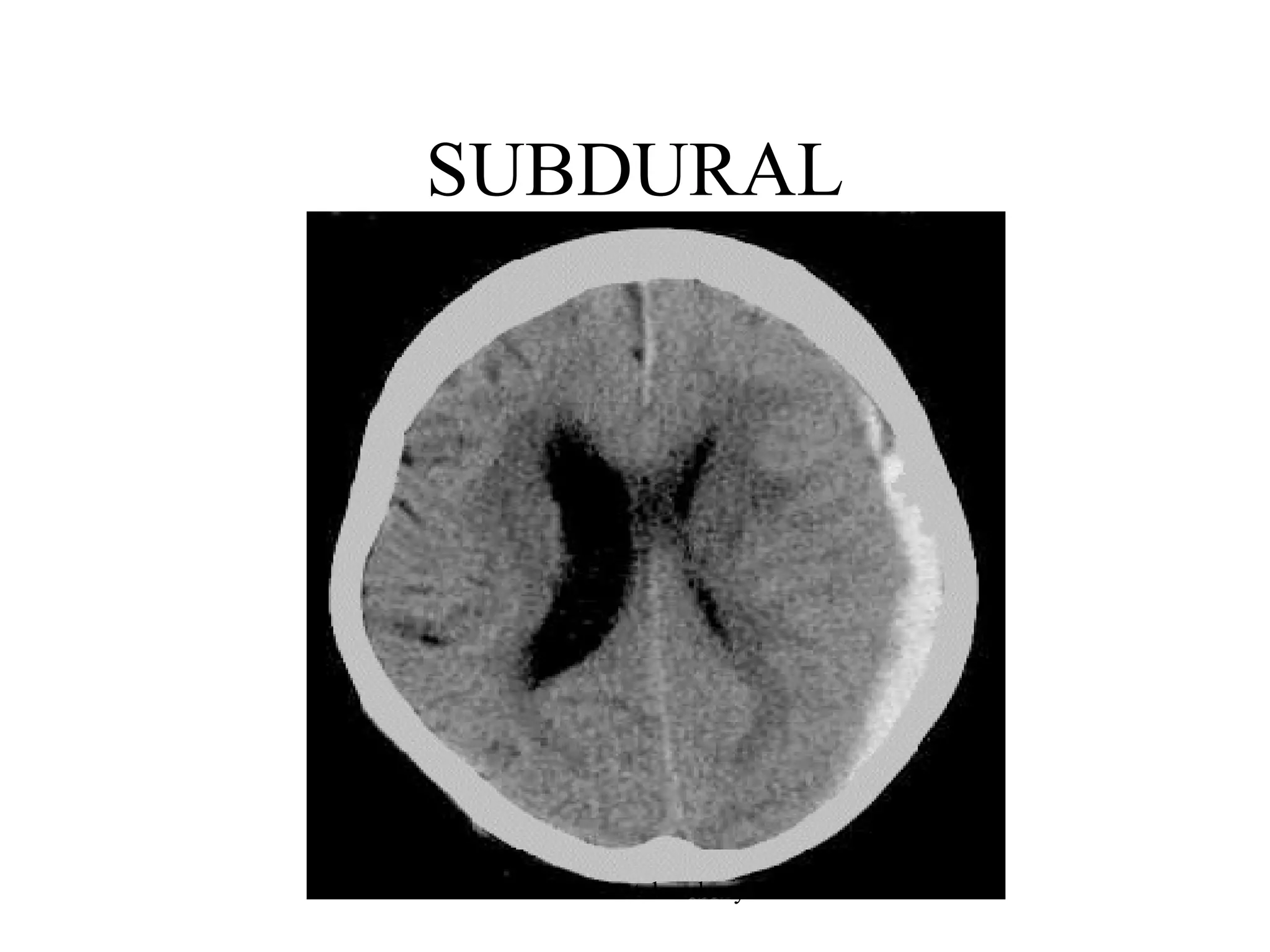 SUBDURAL

www.indiandentalacademy.com

 