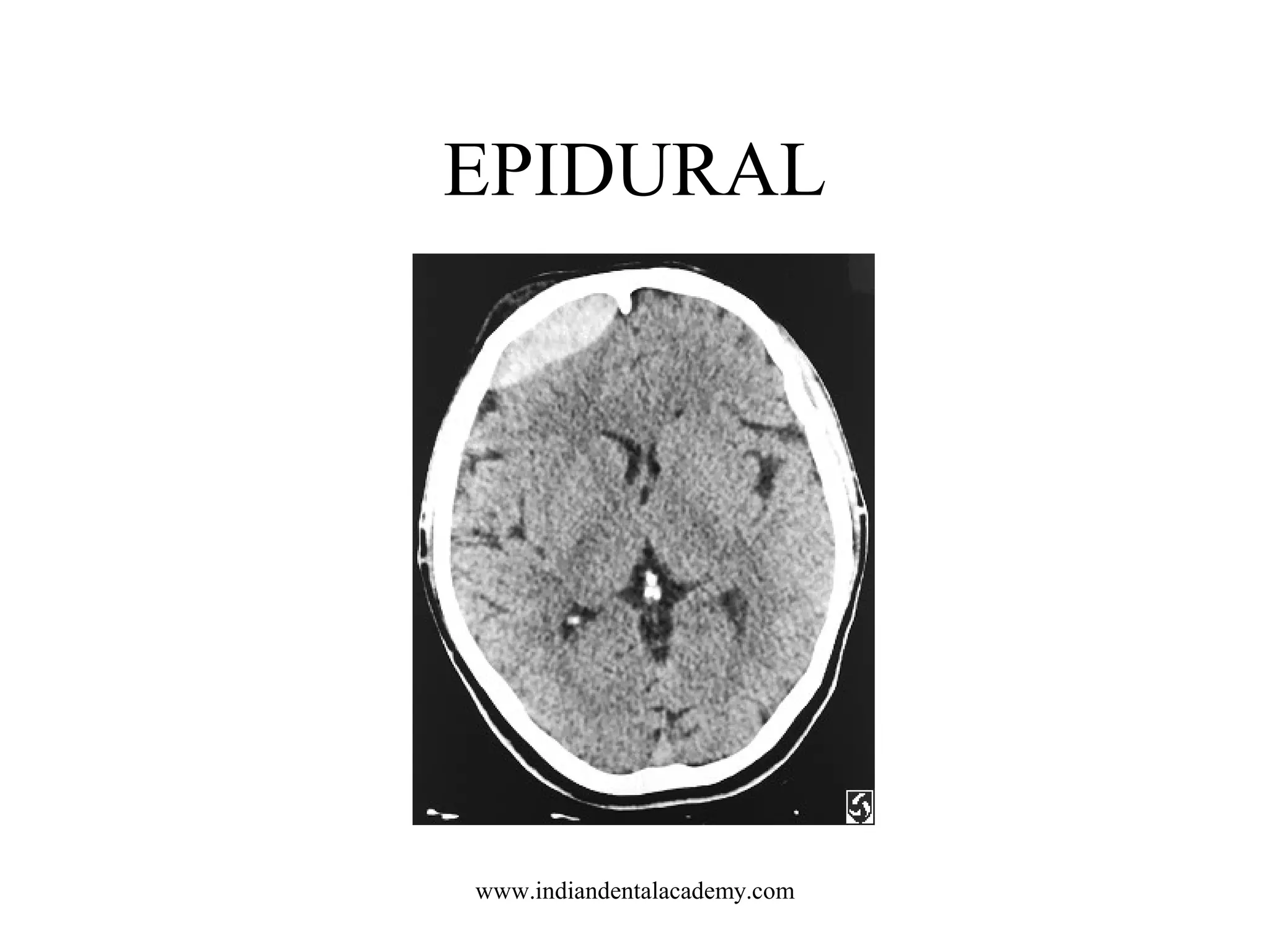 EPIDURAL

www.indiandentalacademy.com

 