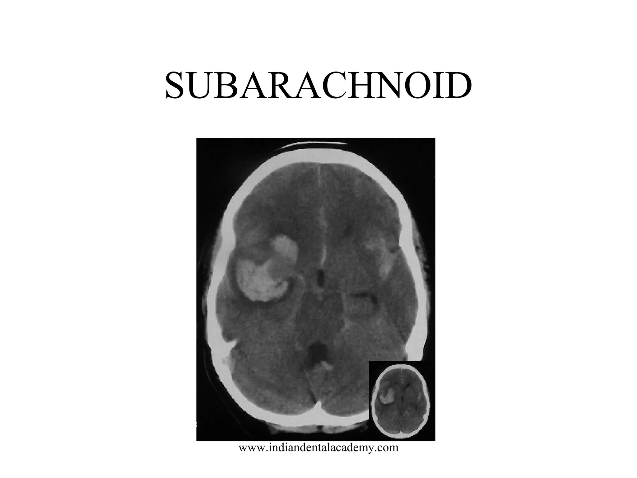 SUBARACHNOID

www.indiandentalacademy.com

 