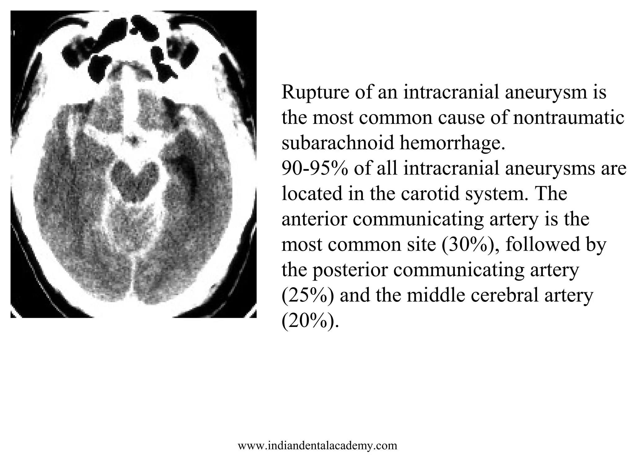 Rupture of an intracranial aneurysm is
the most common cause of nontraumatic
subarachnoid hemorrhage.
90-95% of all intracranial aneurysms are
located in the carotid system. The
anterior communicating artery is the
most common site (30%), followed by
the posterior communicating artery
(25%) and the middle cerebral artery
(20%).

www.indiandentalacademy.com

 