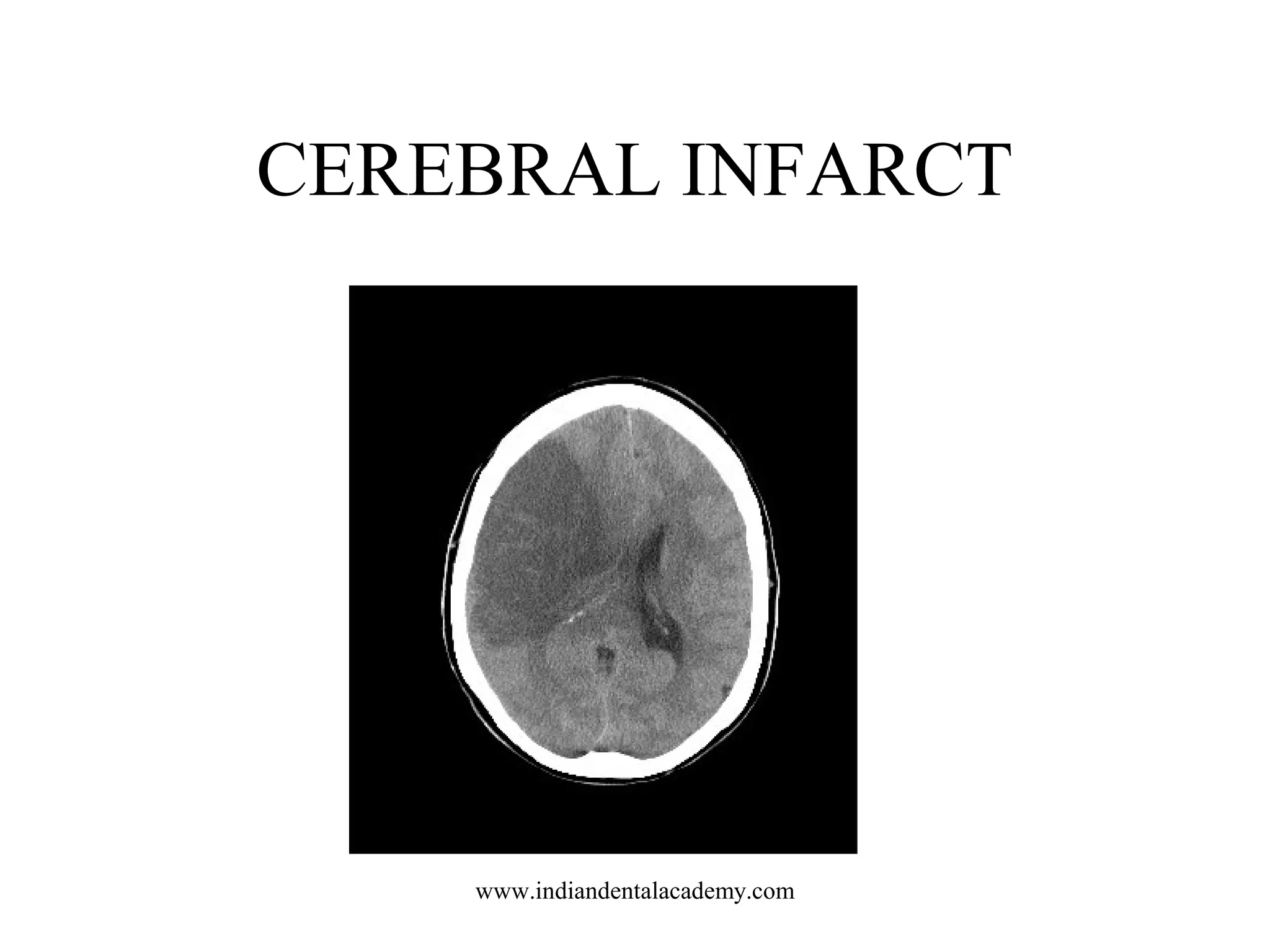 CEREBRAL INFARCT

www.indiandentalacademy.com

 