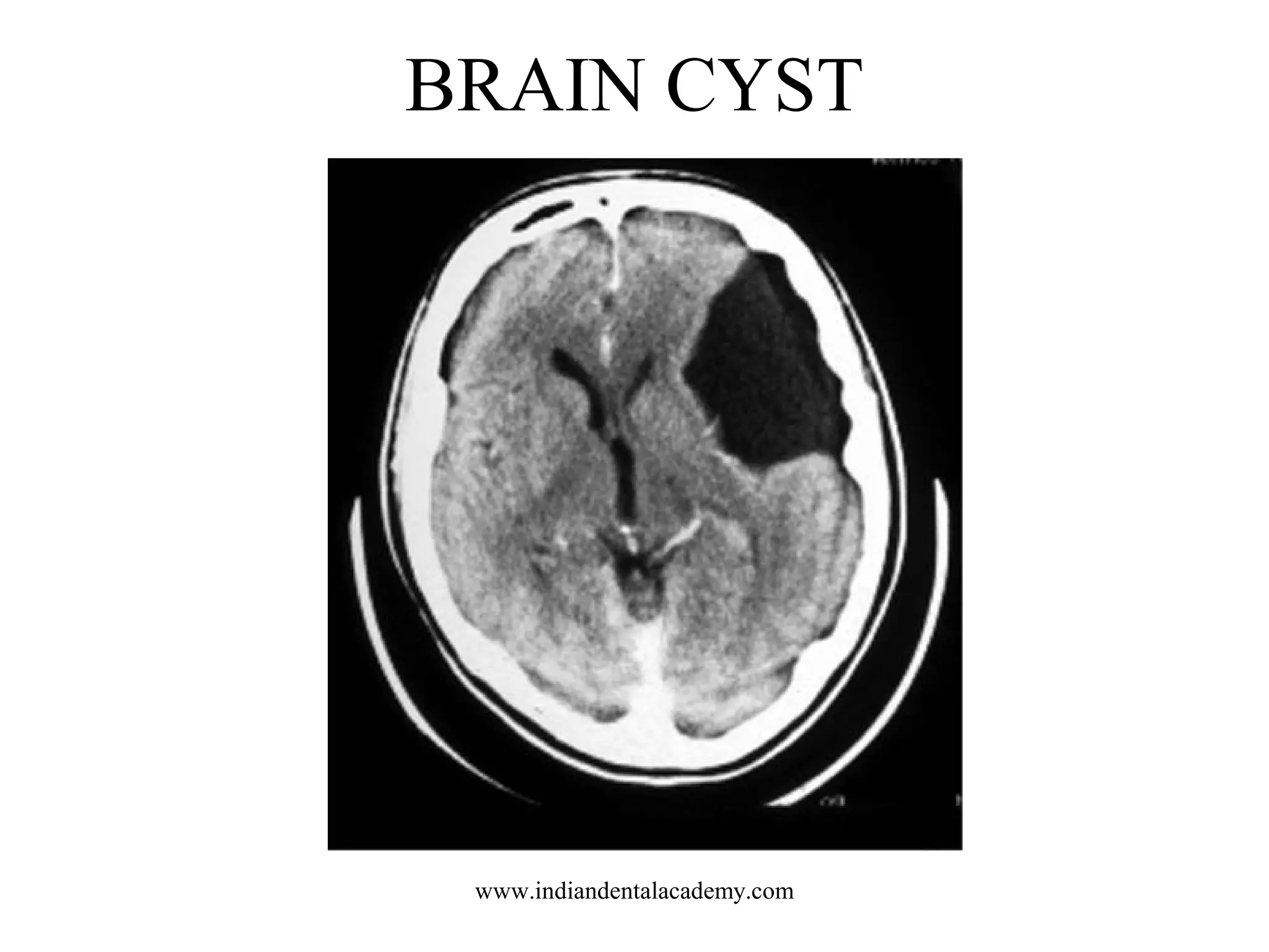 BRAIN CYST

www.indiandentalacademy.com

 