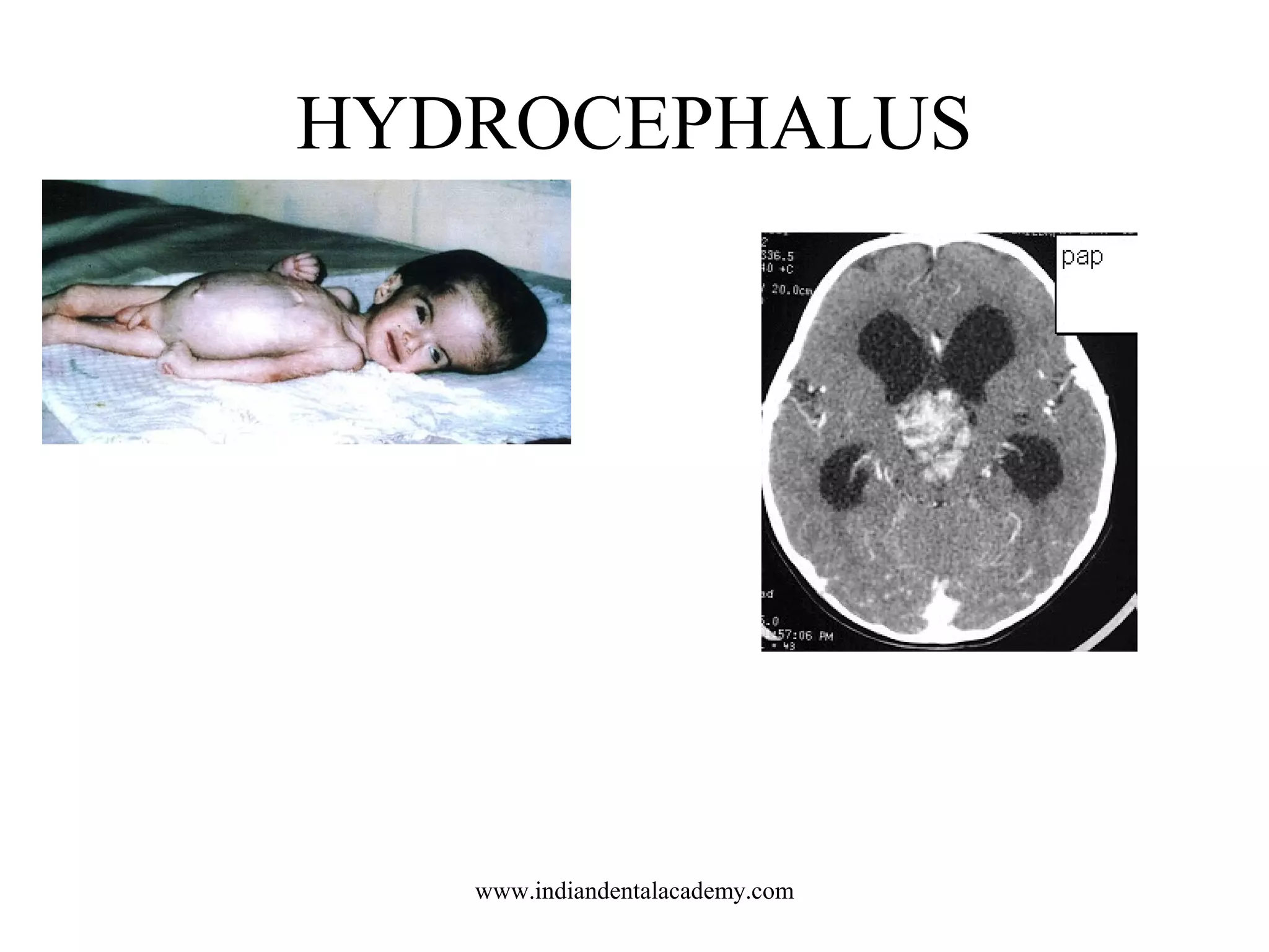 HYDROCEPHALUS

www.indiandentalacademy.com

 