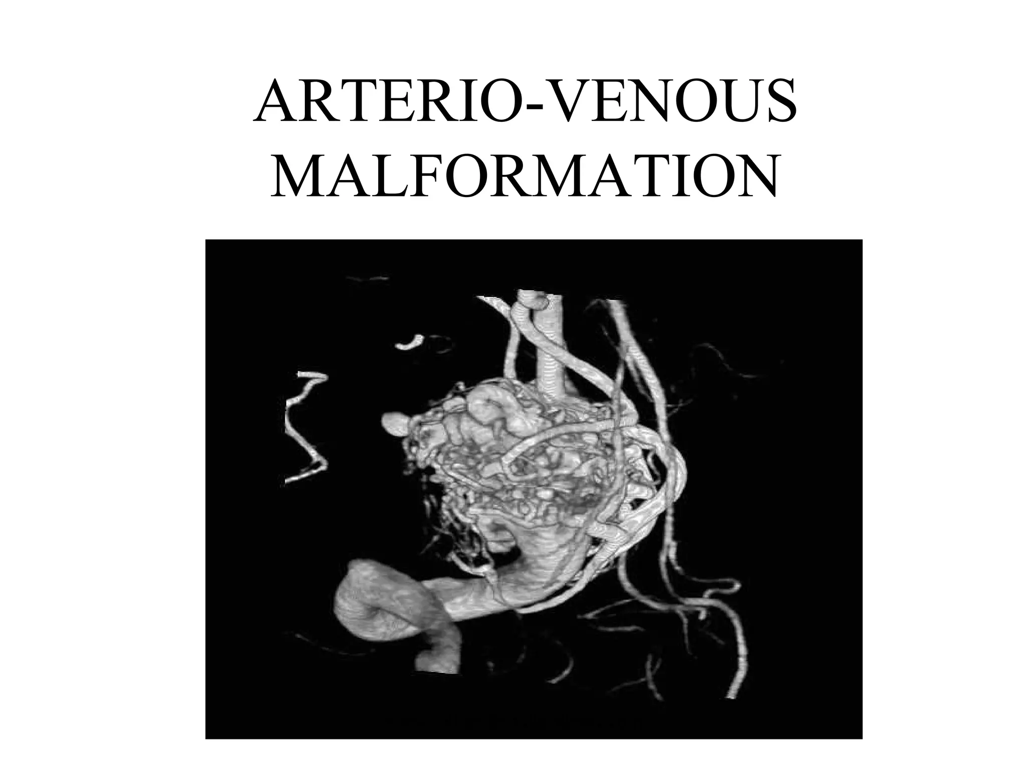 ARTERIO-VENOUS
MALFORMATION

www.indiandentalacademy.com

 