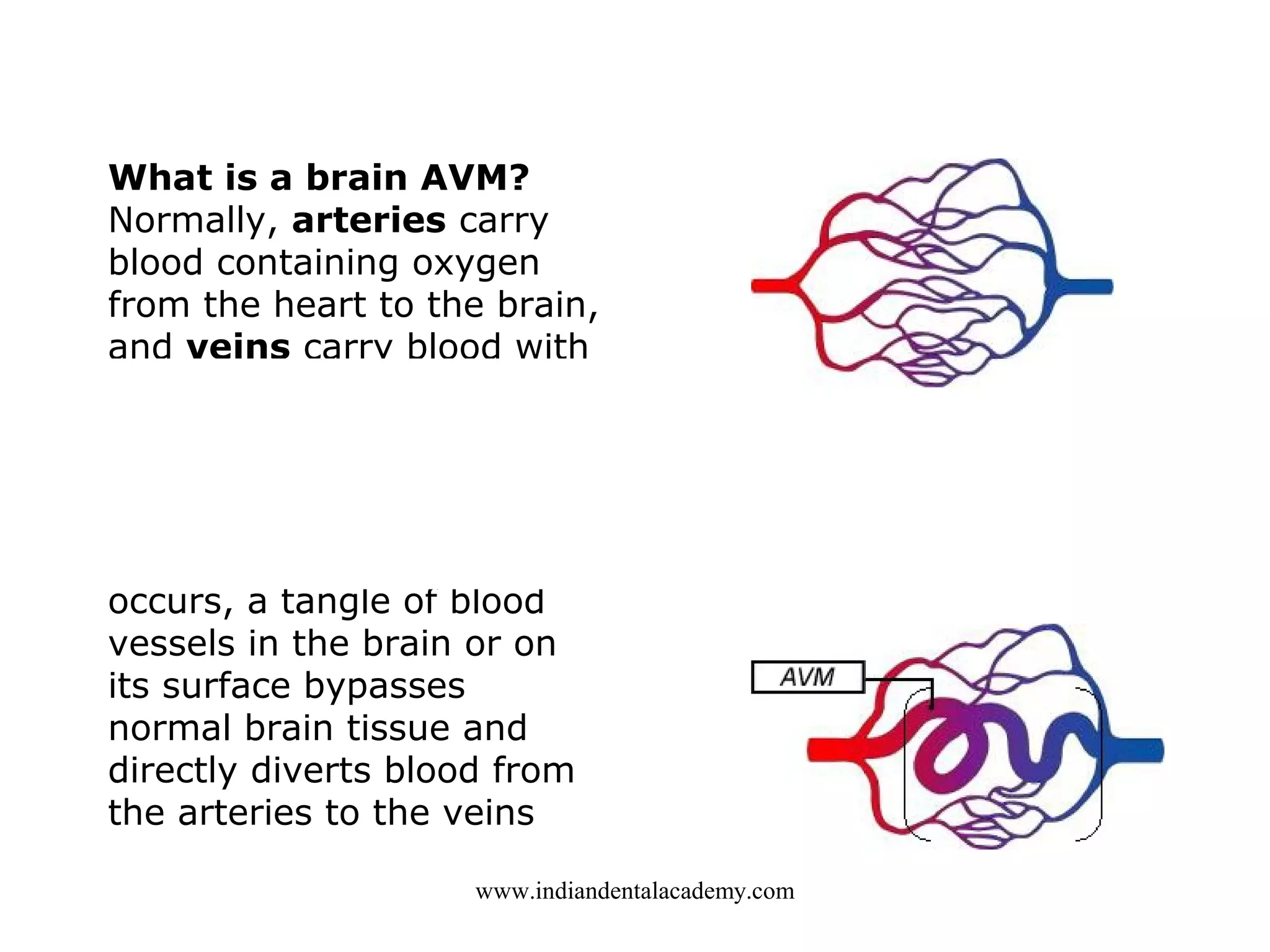 What is a brain AVM?
Normally, arteries carry
blood containing oxygen
from the heart to the brain,
and veins carry blood with
less oxygen away from the
brain and back to the
heart. When an
arteriovenous
malformation (AVM)
occurs, a tangle of blood
vessels in the brain or on
its surface bypasses
normal brain tissue and
directly diverts blood from
the arteries to the veins
www.indiandentalacademy.com

 