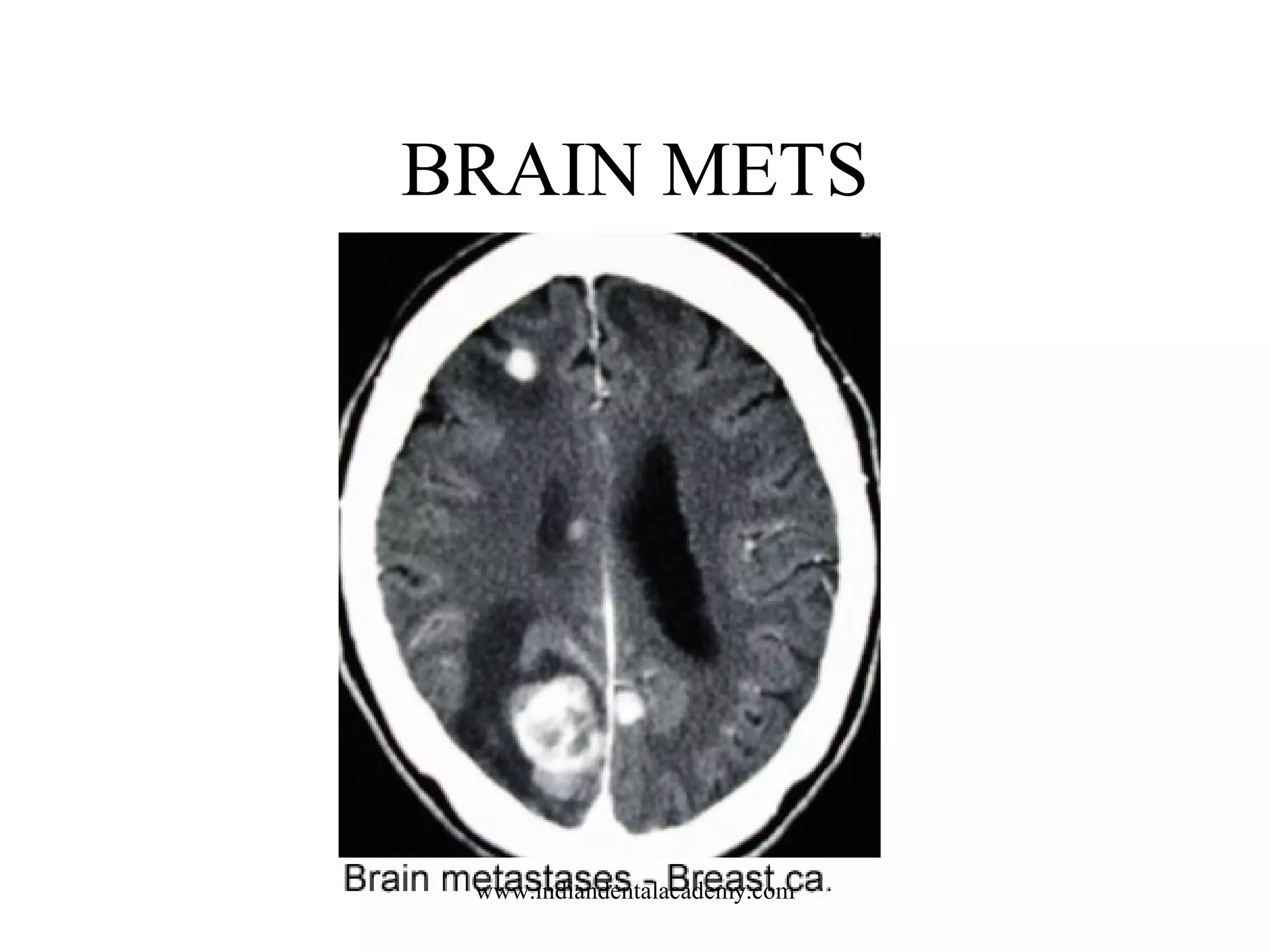BRAIN METS

www.indiandentalacademy.com

 