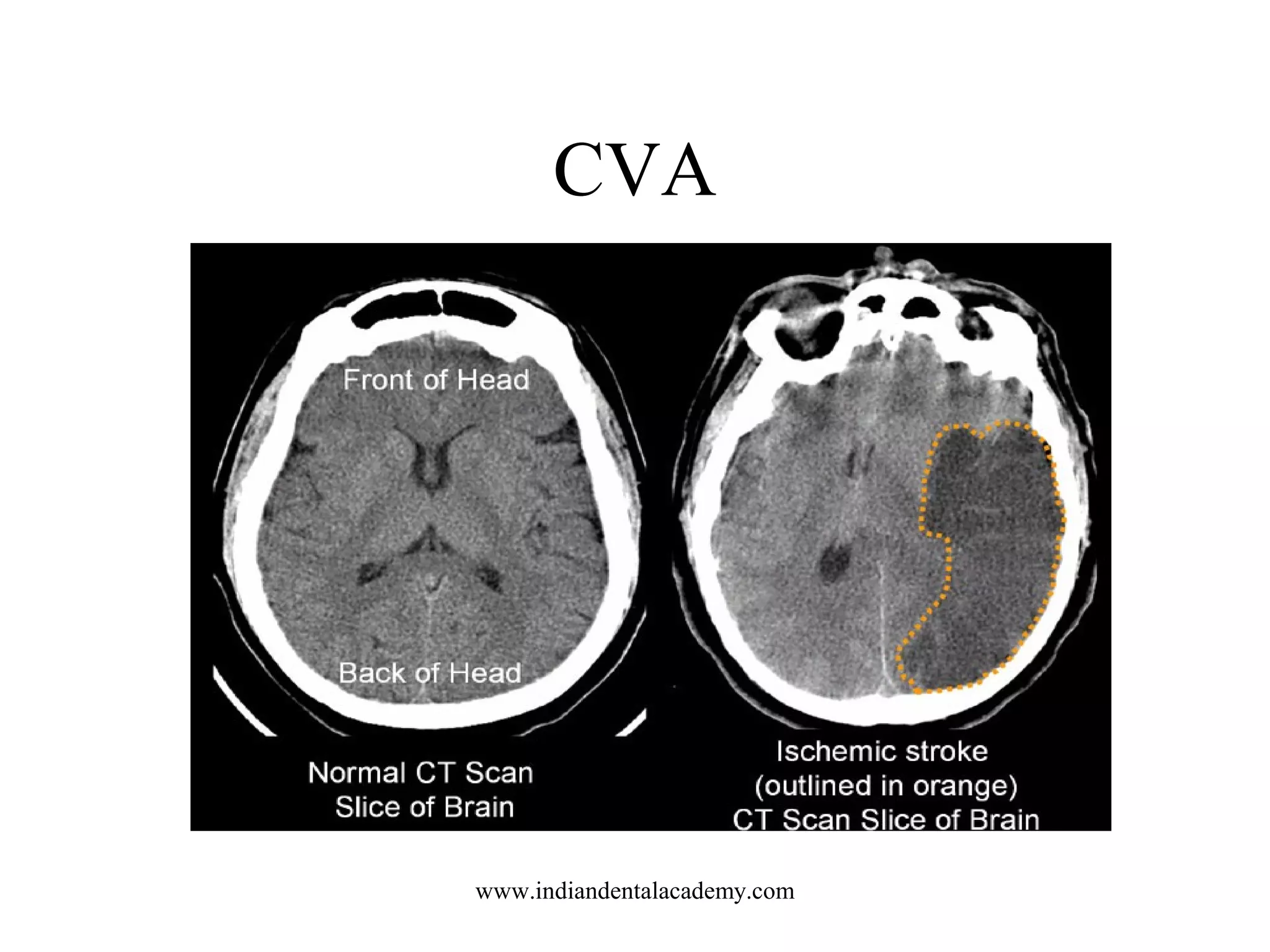 CVA

www.indiandentalacademy.com

 
