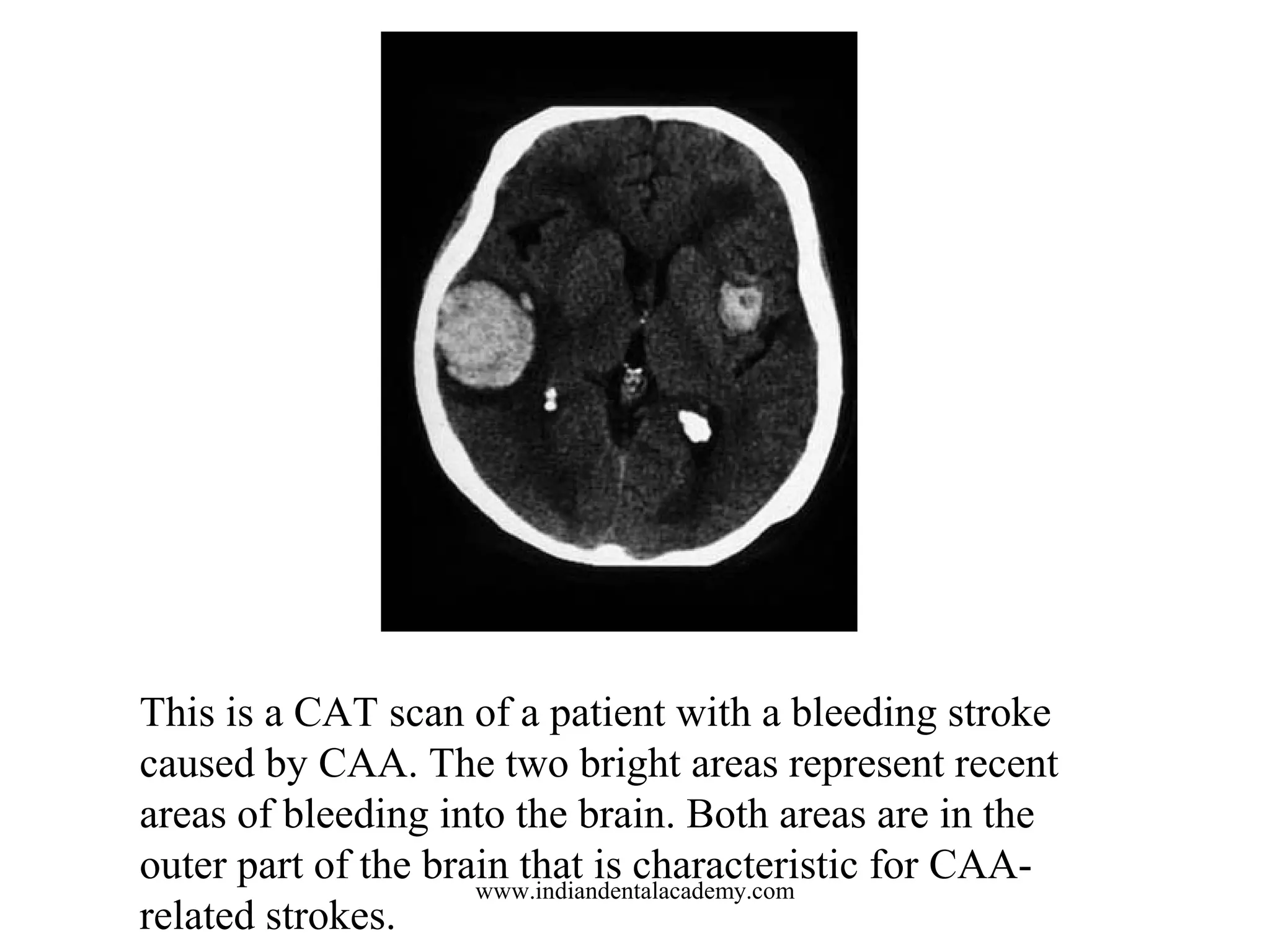 This is a CAT scan of a patient with a bleeding stroke
caused by CAA. The two bright areas represent recent
areas of bleeding into the brain. Both areas are in the
outer part of the brain that is characteristic for CAAwww.indiandentalacademy.com
related strokes.

 