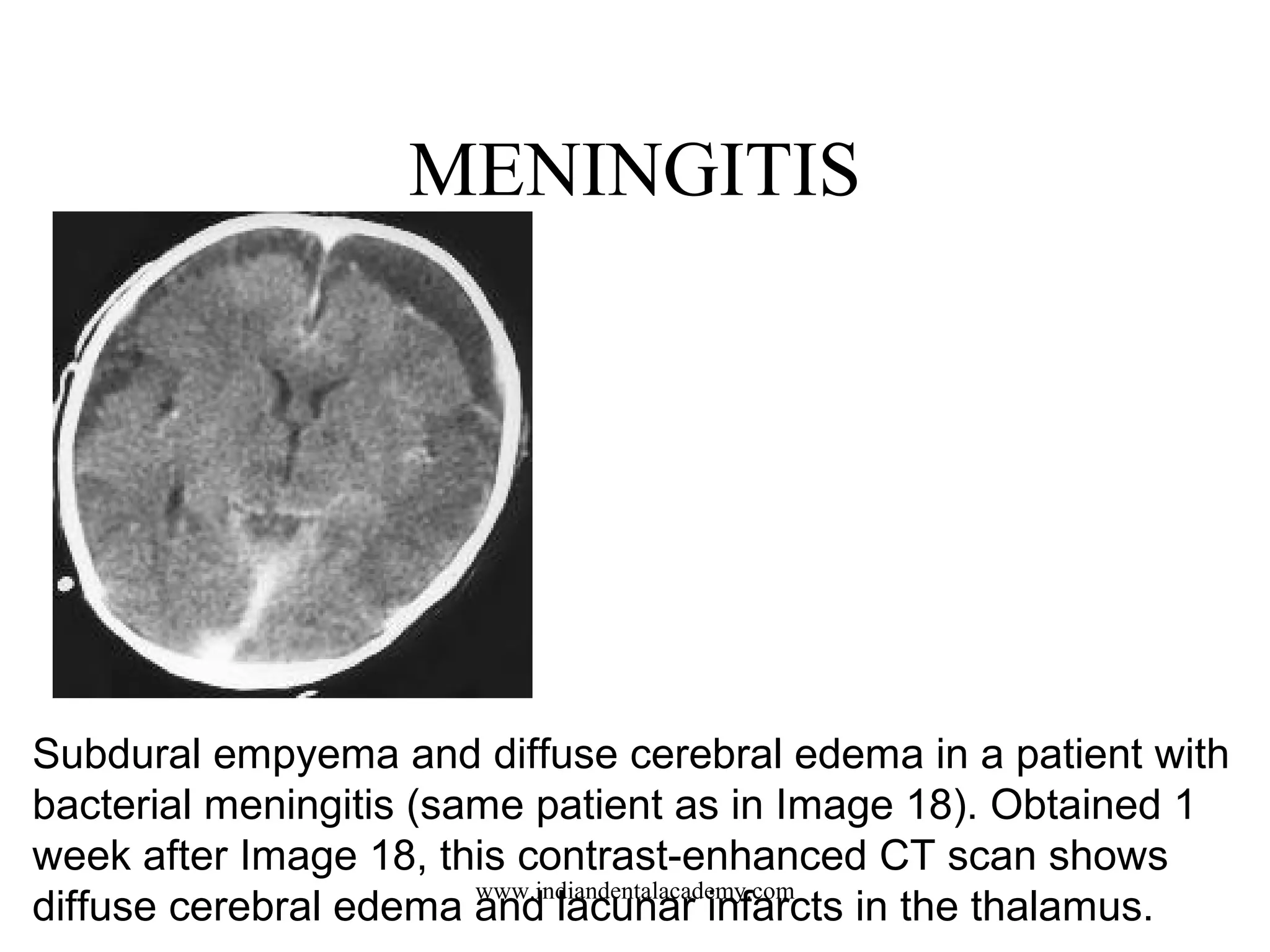 MENINGITIS

Subdural empyema and diffuse cerebral edema in a patient with
bacterial meningitis (same patient as in Image 18). Obtained 1
week after Image 18, this contrast-enhanced CT scan shows
www.indiandentalacademy.com
diffuse cerebral edema and lacunar infarcts in the thalamus.

 
