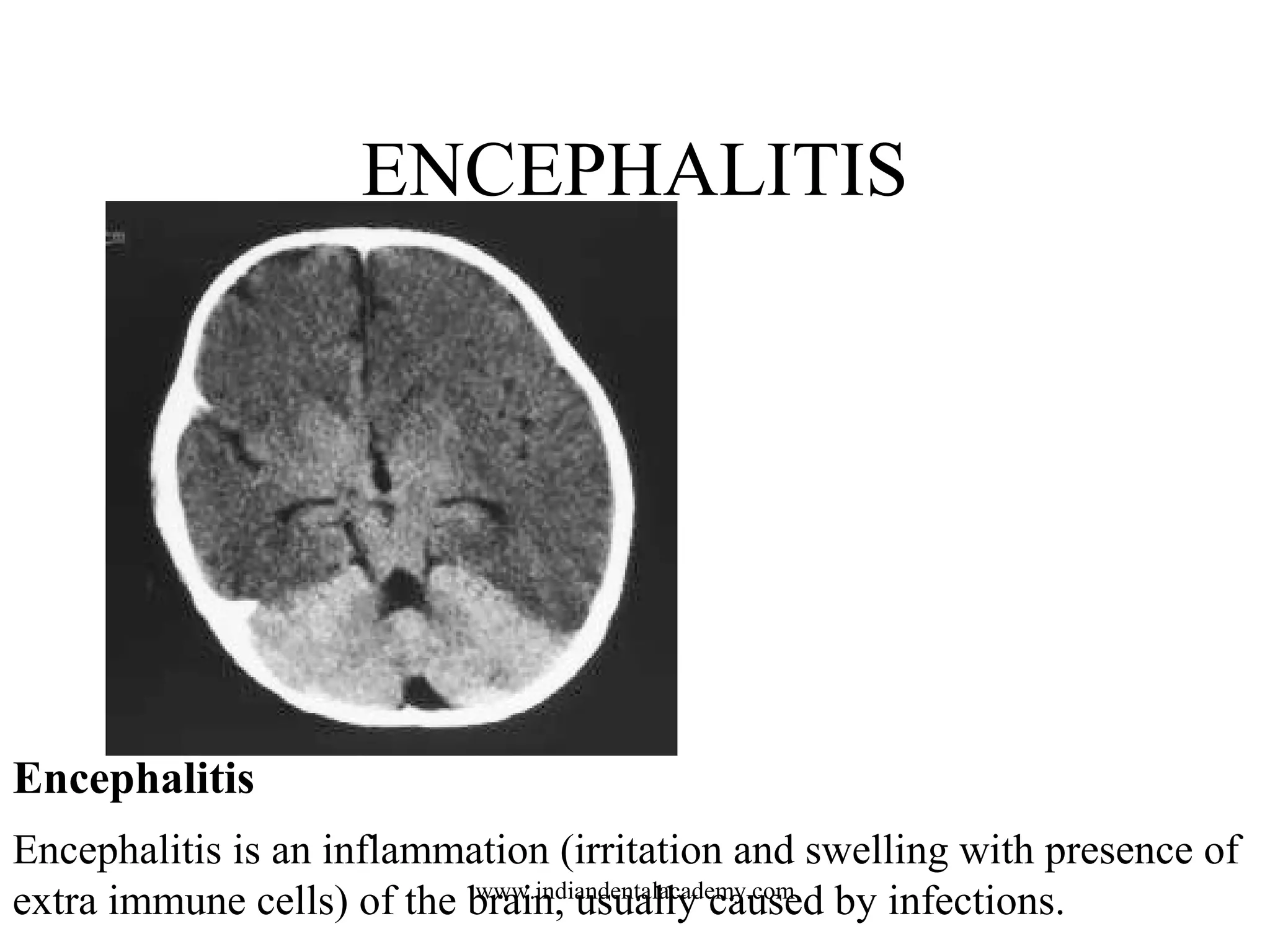 ENCEPHALITIS

Encephalitis
Encephalitis is an inflammation (irritation and swelling with presence of
www.indiandentalacademy.com
extra immune cells) of the brain, usually caused by infections.

 