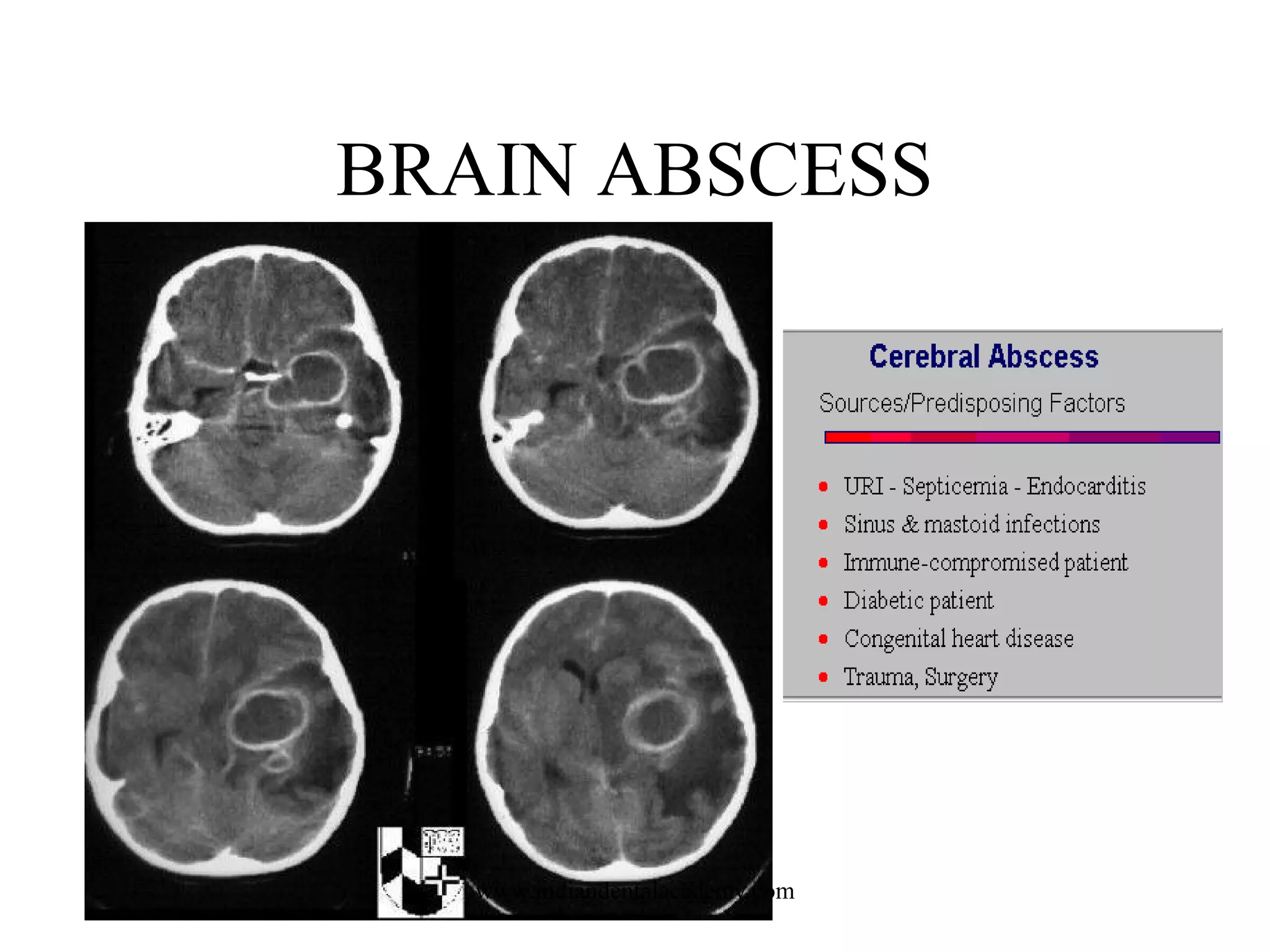 BRAIN ABSCESS

www.indiandentalacademy.com

 