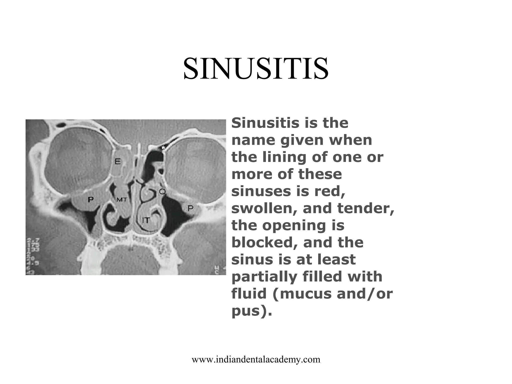SINUSITIS
Sinusitis is the
name given when
the lining of one or
more of these
sinuses is red,
swollen, and tender,
the opening is
blocked, and the
sinus is at least
partially filled with
fluid (mucus and/or
pus).
www.indiandentalacademy.com

 