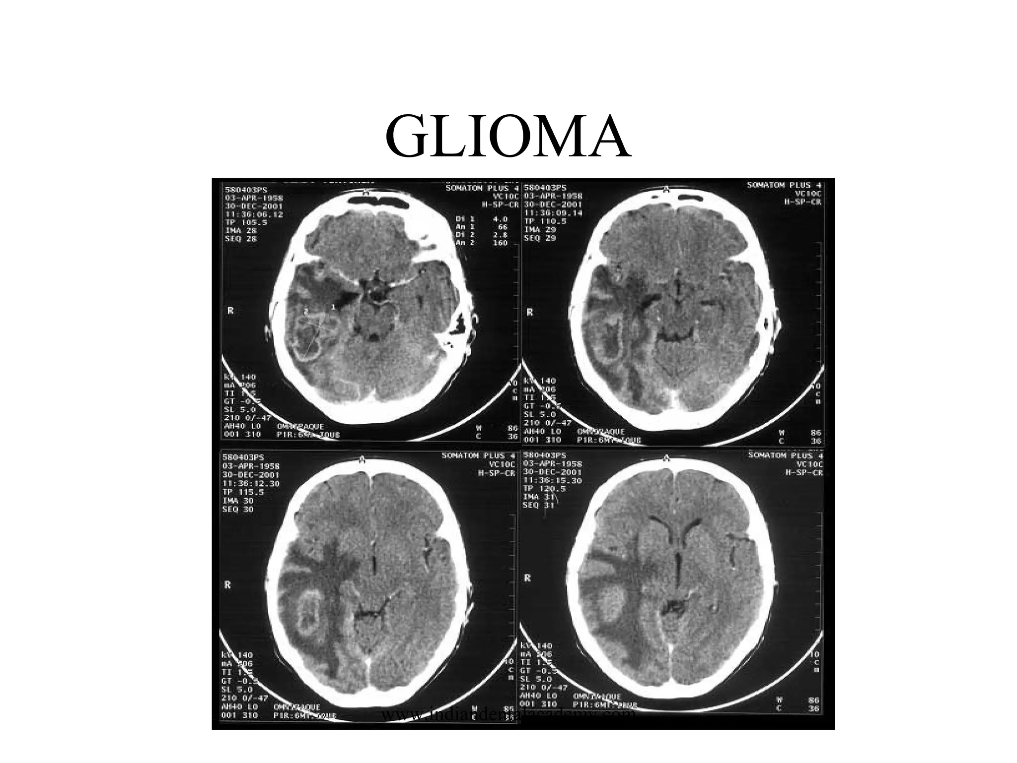 GLIOMA

www.indiandentalacademy.com

 
