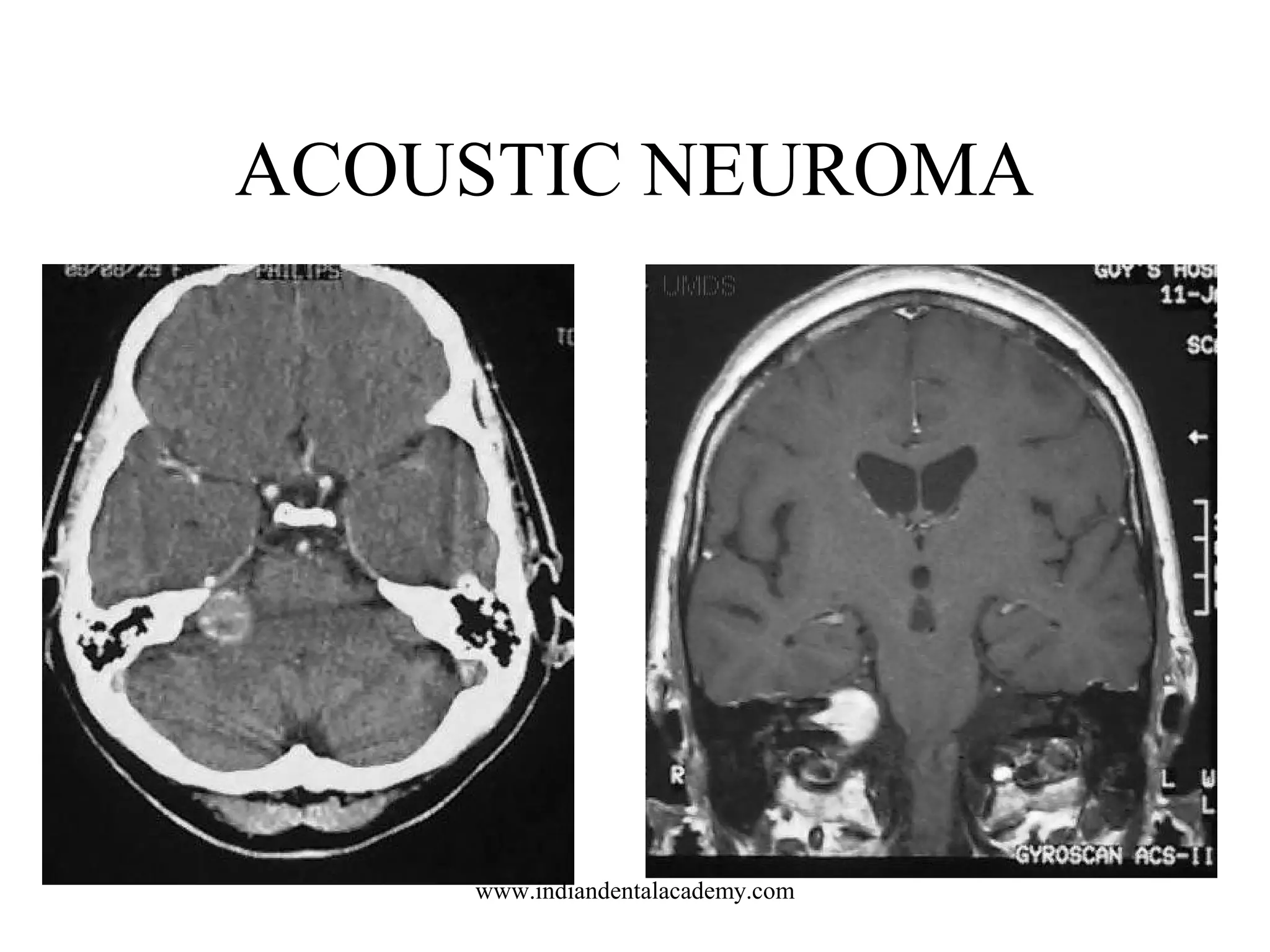 ACOUSTIC NEUROMA

www.indiandentalacademy.com

 