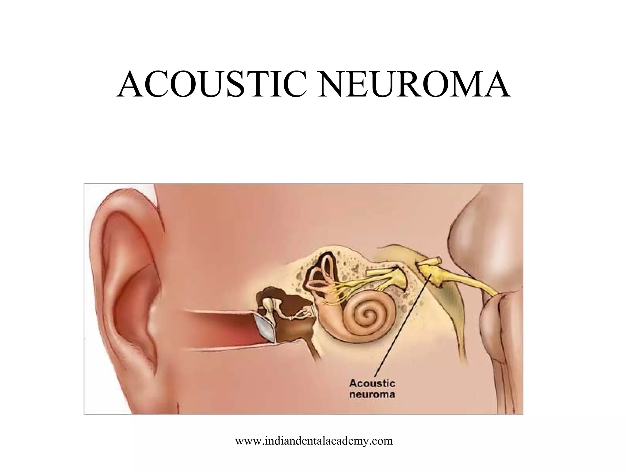 ACOUSTIC NEUROMA

www.indiandentalacademy.com

 