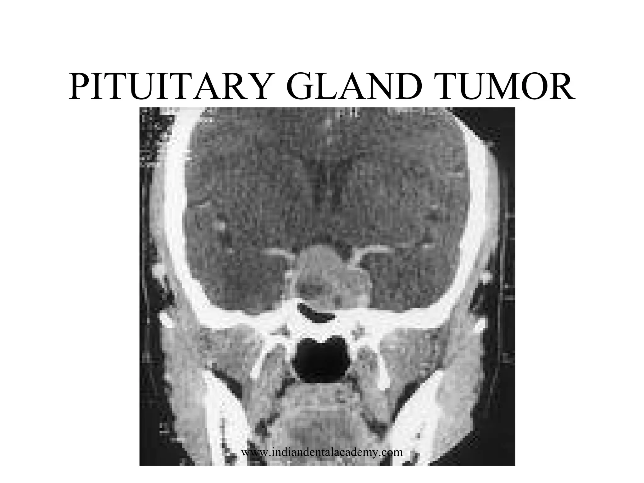 PITUITARY GLAND TUMOR

www.indiandentalacademy.com

 