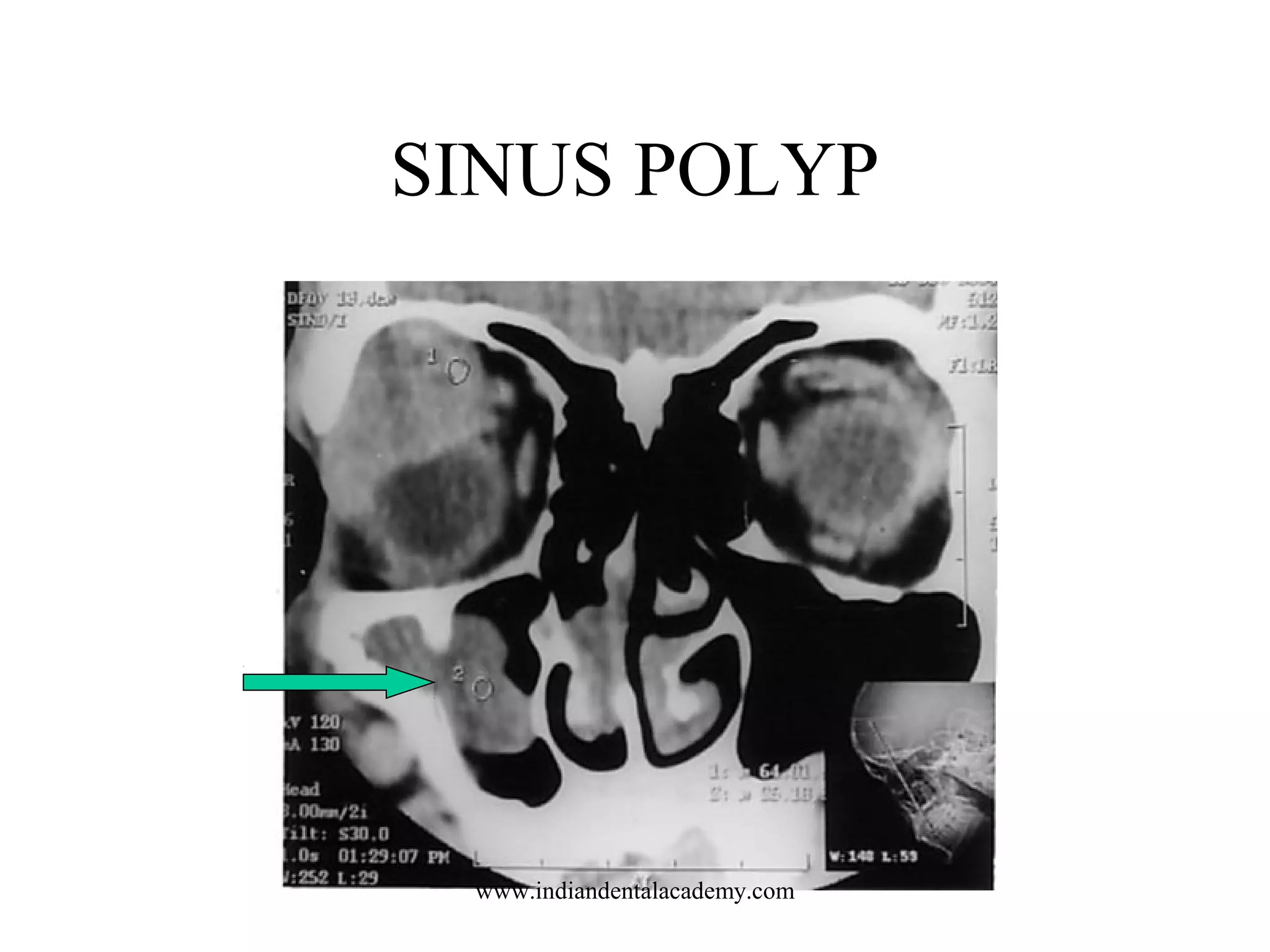 SINUS POLYP

www.indiandentalacademy.com

 