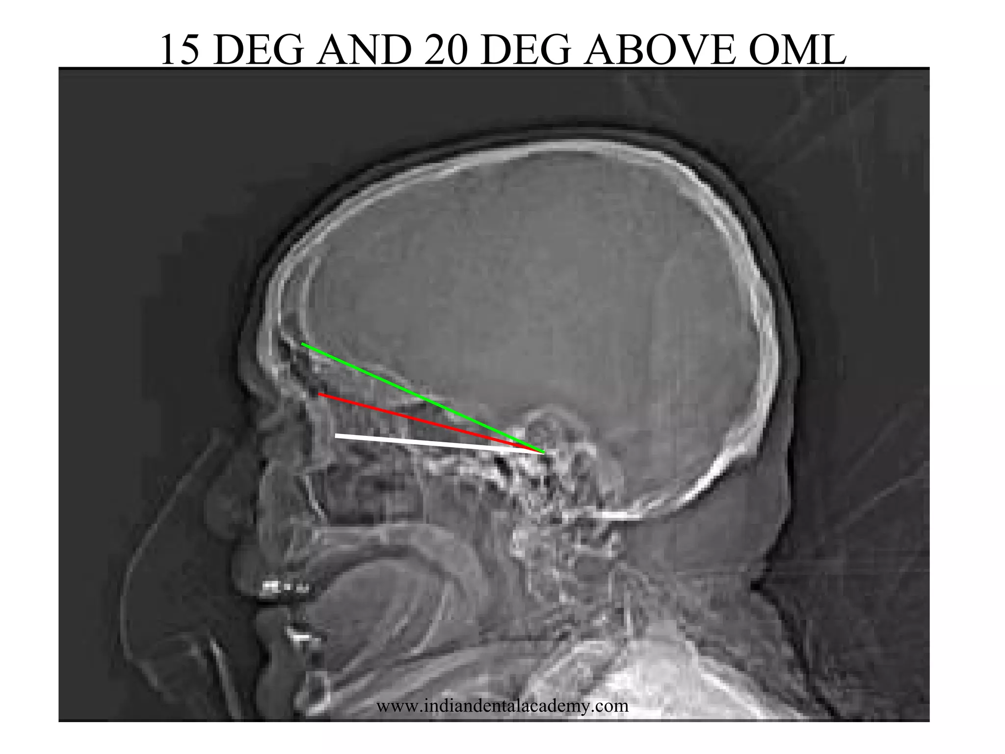 15 DEG AND 20 DEG ABOVE OML

www.indiandentalacademy.com

 