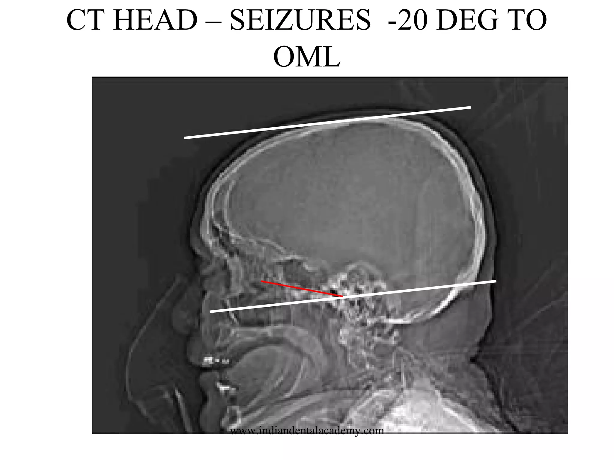 CT HEAD – SEIZURES -20 DEG TO
OML

www.indiandentalacademy.com

 