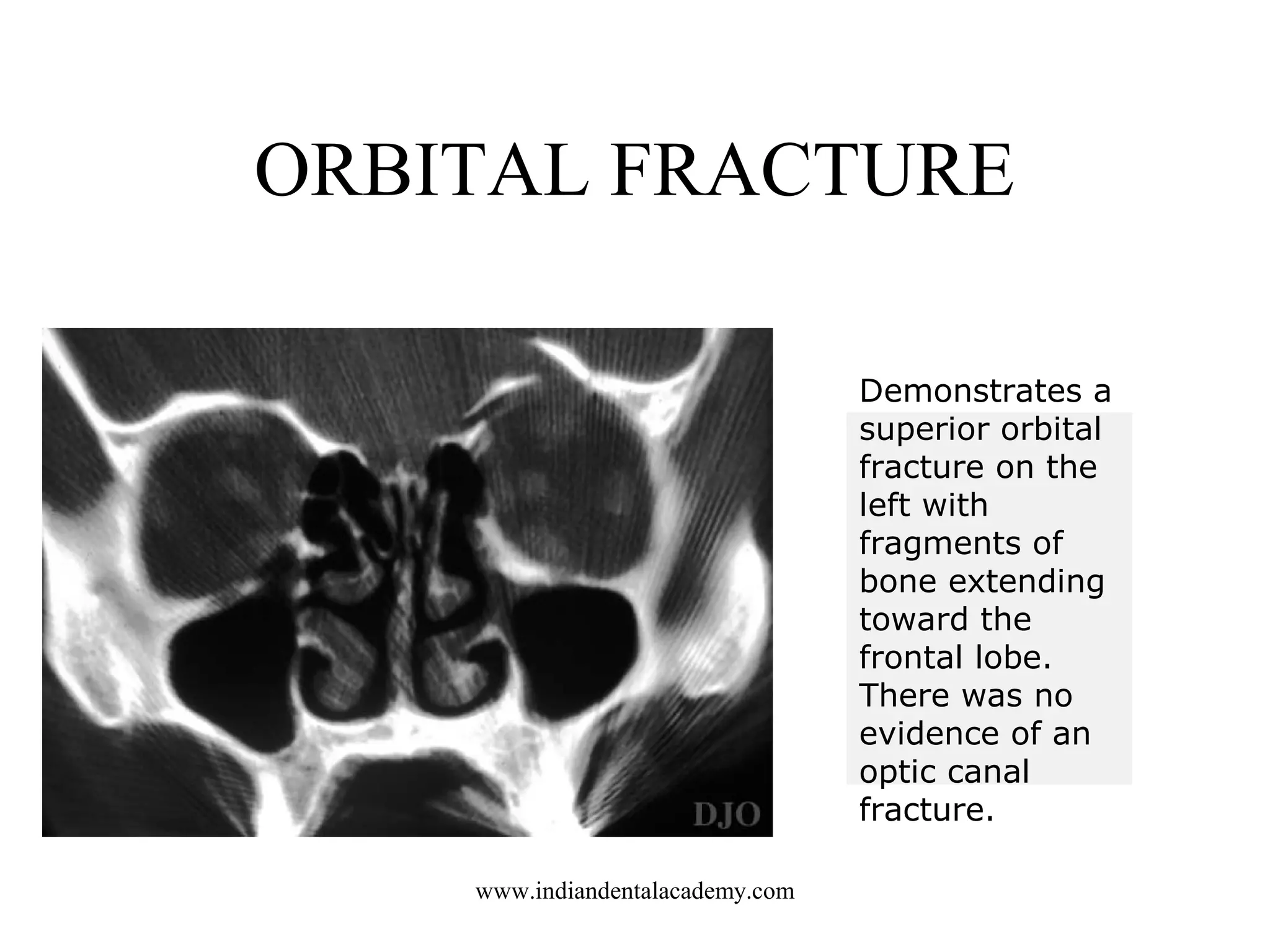 ORBITAL FRACTURE
Demonstrates a
superior orbital
fracture on the
left with
fragments of
bone extending
toward the
frontal lobe.
There was no
evidence of an
optic canal
fracture.
www.indiandentalacademy.com

 