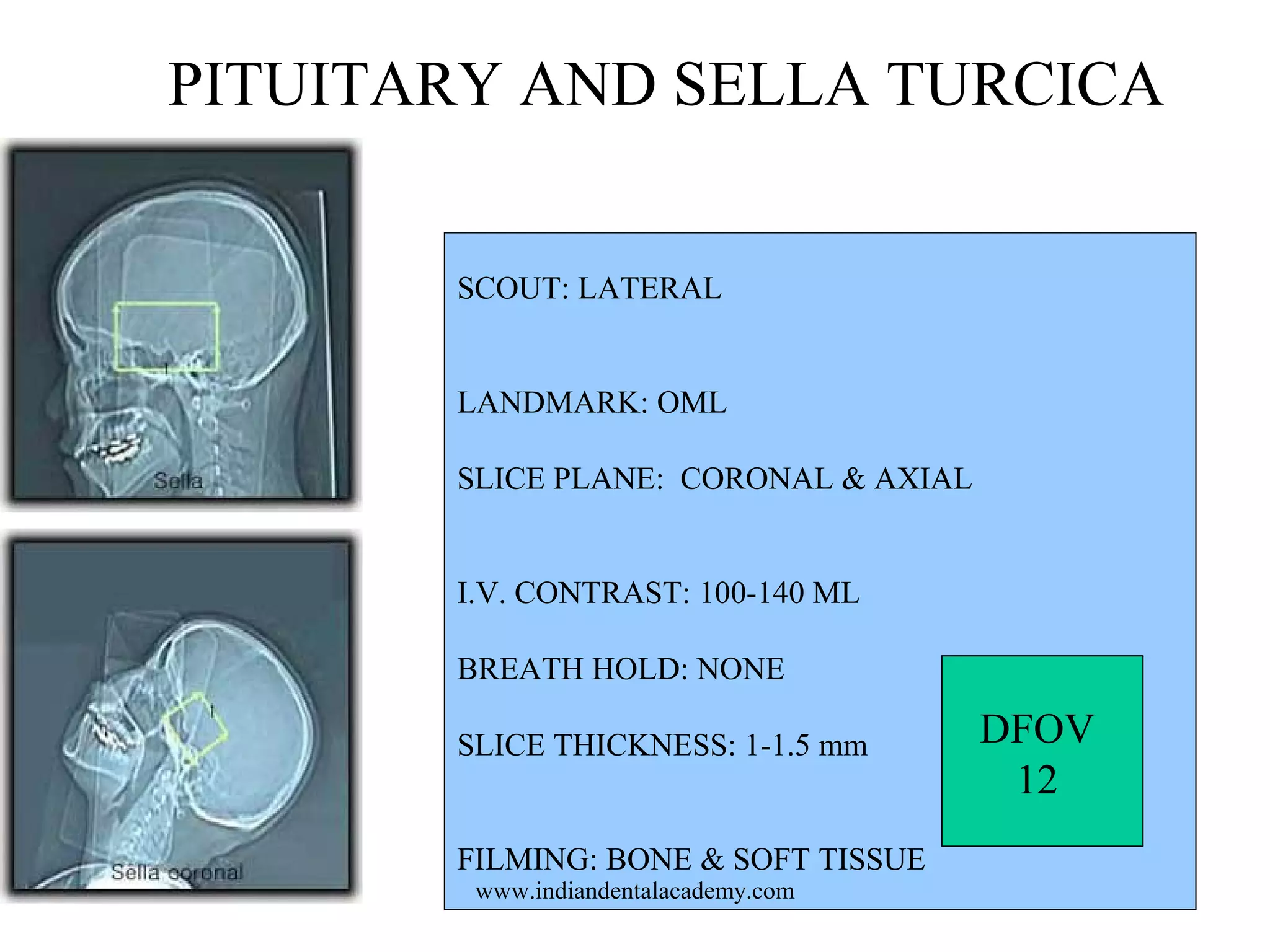 PITUITARY AND SELLA TURCICA
SCOUT: LATERAL
LANDMARK: OML
SLICE PLANE: CORONAL & AXIAL
I.V. CONTRAST: 100-140 ML
BREATH HOLD: NONE
SLICE THICKNESS: 1-1.5 mm
FILMING: BONE & SOFT TISSUE
www.indiandentalacademy.com

DFOV
12

 