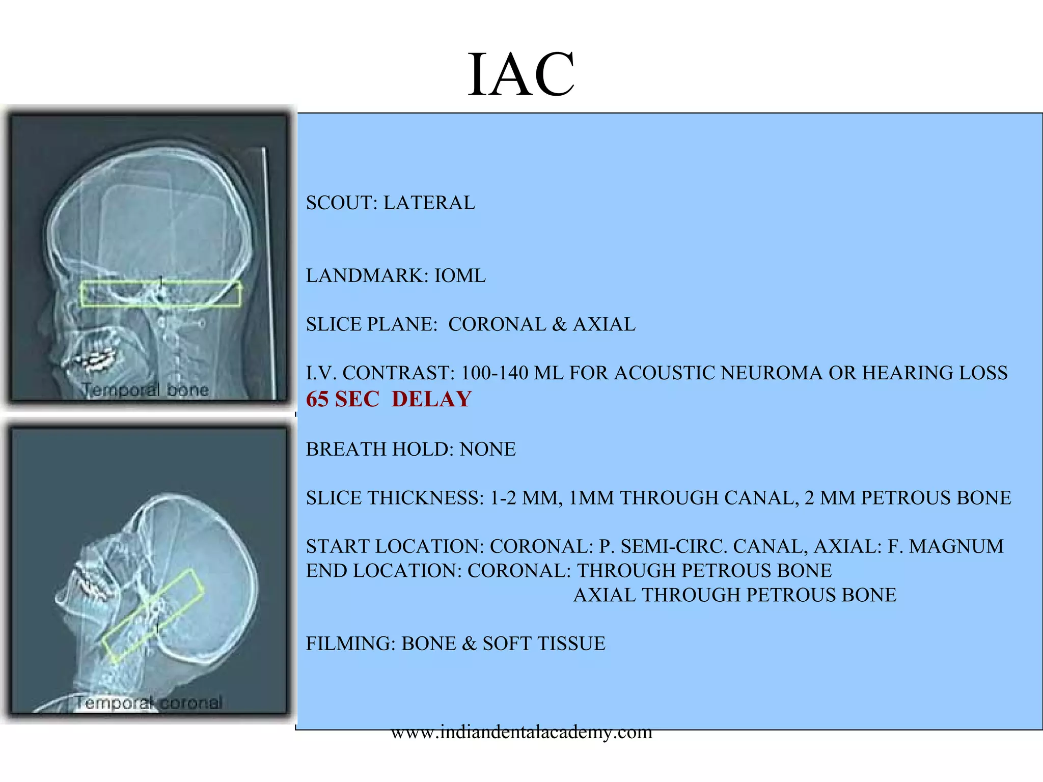 IAC
SCOUT: LATERAL
LANDMARK: IOML
SLICE PLANE: CORONAL & AXIAL
I.V. CONTRAST: 100-140 ML FOR ACOUSTIC NEUROMA OR HEARING LOSS

65 SEC DELAY
BREATH HOLD: NONE
SLICE THICKNESS: 1-2 MM, 1MM THROUGH CANAL, 2 MM PETROUS BONE
START LOCATION: CORONAL: P. SEMI-CIRC. CANAL, AXIAL: F. MAGNUM
END LOCATION: CORONAL: THROUGH PETROUS BONE
AXIAL THROUGH PETROUS BONE
FILMING: BONE & SOFT TISSUE

www.indiandentalacademy.com

 