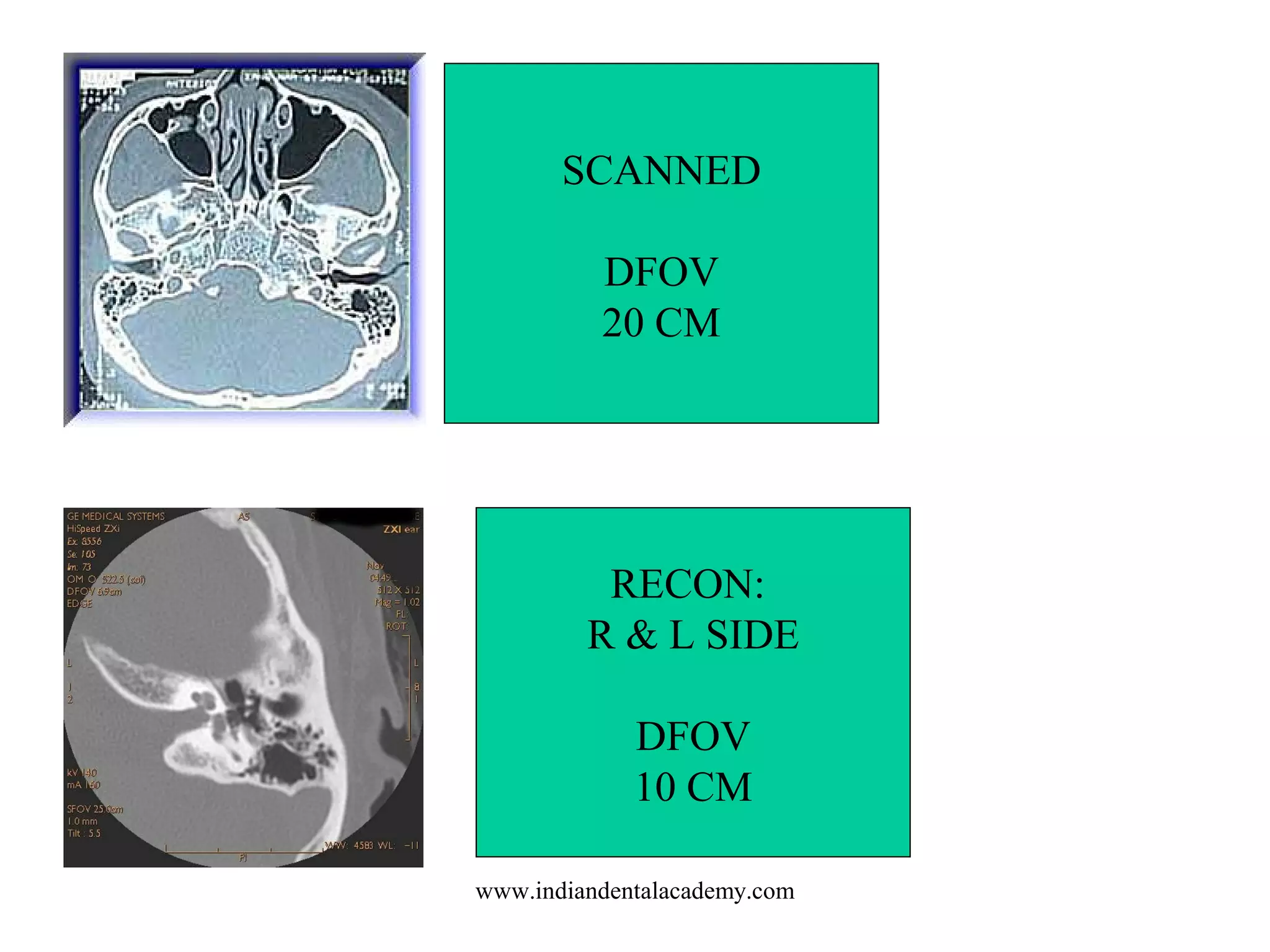 SCANNED
DFOV
20 CM

RECON:
R & L SIDE
DFOV
10 CM
www.indiandentalacademy.com

 