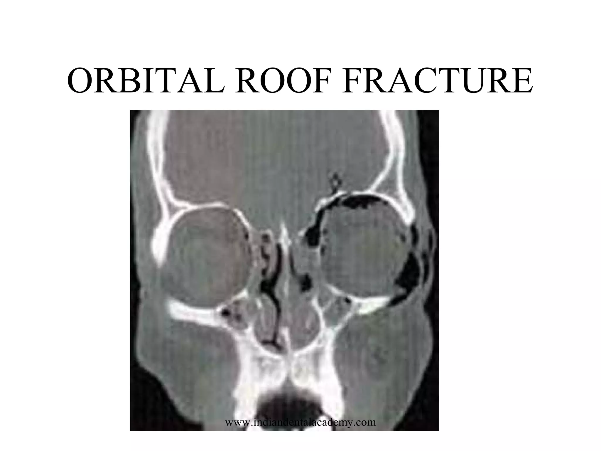 ORBITAL ROOF FRACTURE

www.indiandentalacademy.com

 