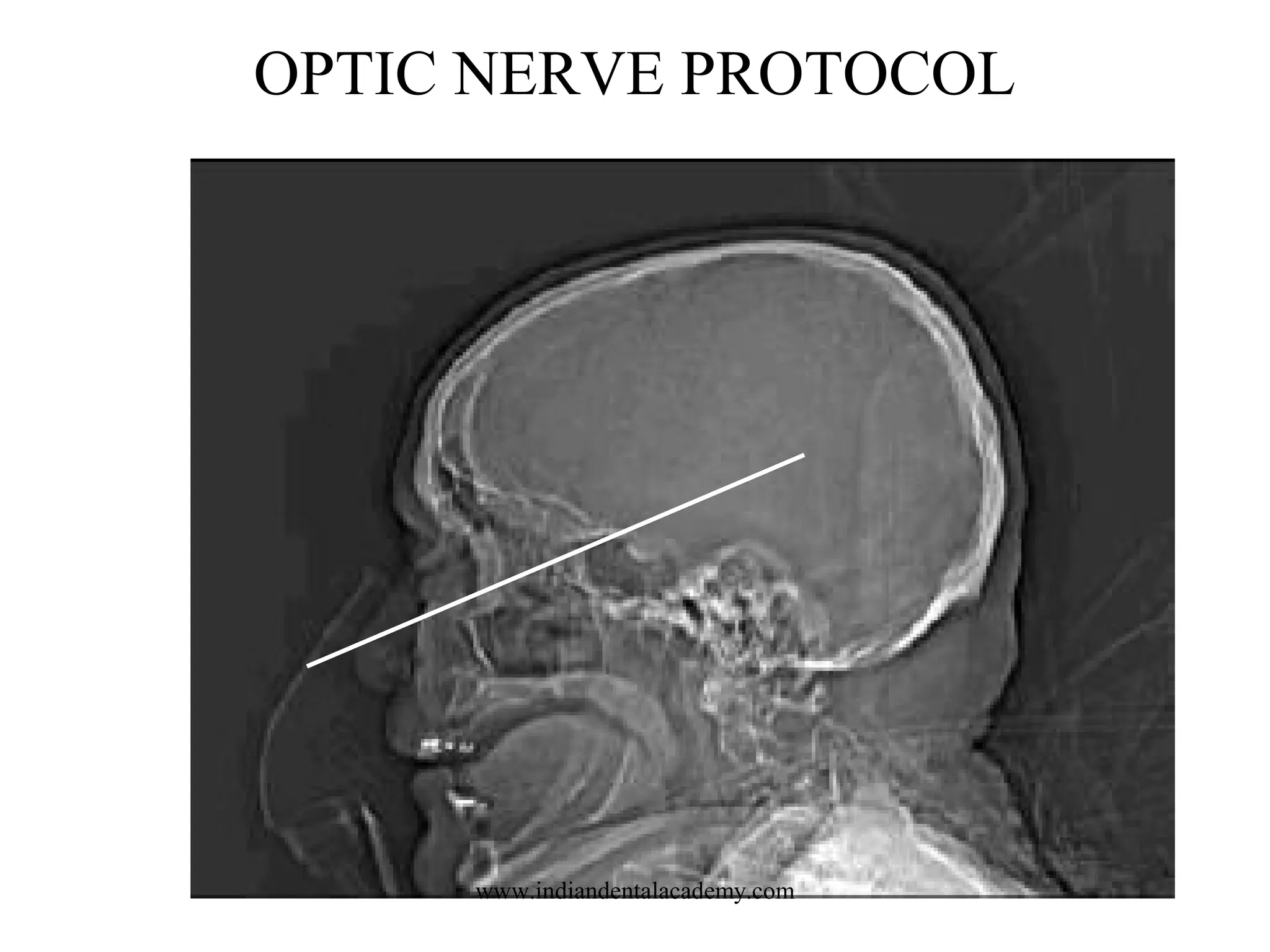 OPTIC NERVE PROTOCOL

www.indiandentalacademy.com

 
