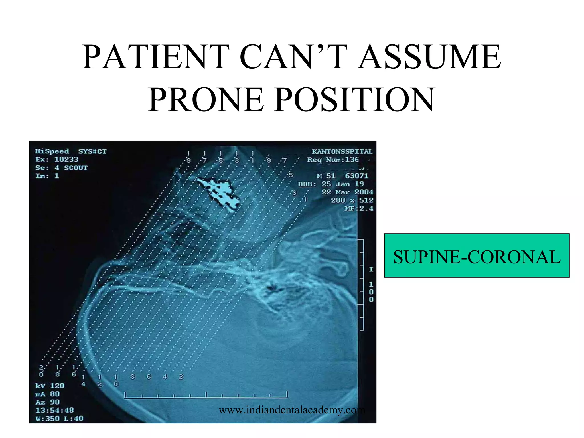 PATIENT CAN’T ASSUME
PRONE POSITION

SUPINE-CORONAL

www.indiandentalacademy.com

 
