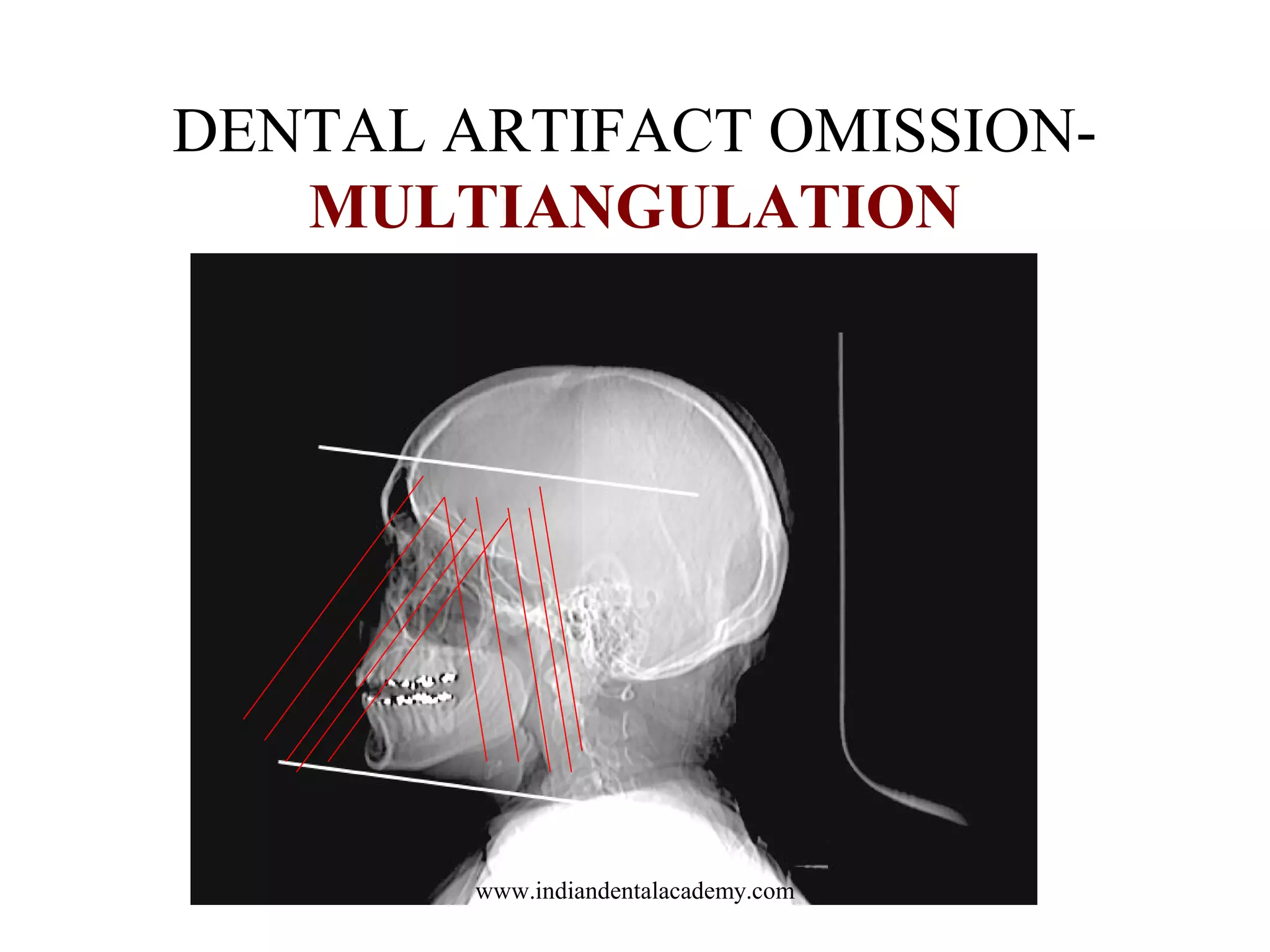 DENTAL ARTIFACT OMISSIONMULTIANGULATION

www.indiandentalacademy.com

 