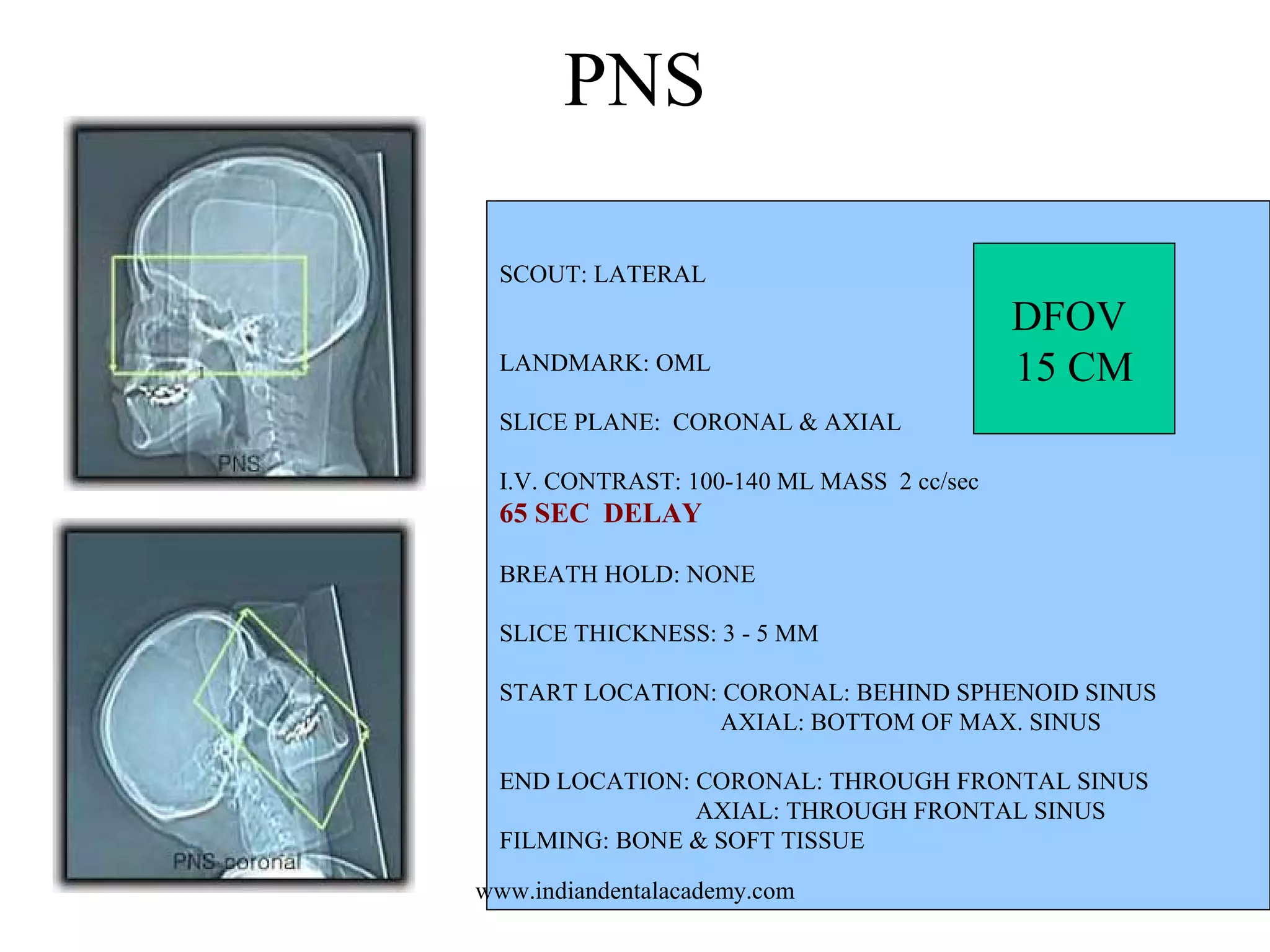PNS
SCOUT: LATERAL
LANDMARK: OML

DFOV
15 CM

SLICE PLANE: CORONAL & AXIAL
I.V. CONTRAST: 100-140 ML MASS 2 cc/sec

65 SEC DELAY
BREATH HOLD: NONE
SLICE THICKNESS: 3 - 5 MM
START LOCATION: CORONAL: BEHIND SPHENOID SINUS
AXIAL: BOTTOM OF MAX. SINUS
END LOCATION: CORONAL: THROUGH FRONTAL SINUS
AXIAL: THROUGH FRONTAL SINUS
FILMING: BONE & SOFT TISSUE
www.indiandentalacademy.com

 