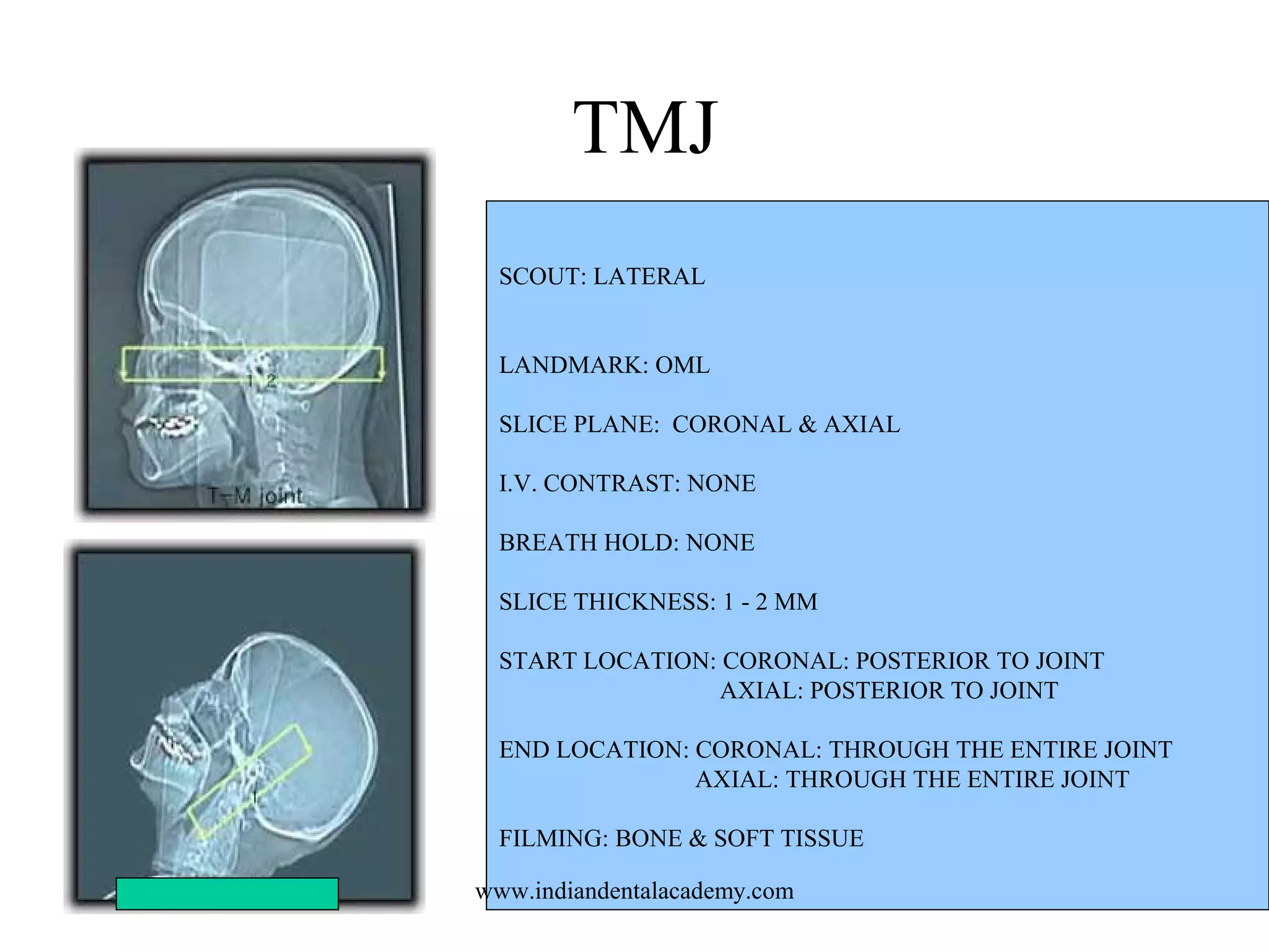 TMJ
SCOUT: LATERAL
LANDMARK: OML
SLICE PLANE: CORONAL & AXIAL
I.V. CONTRAST: NONE
BREATH HOLD: NONE
SLICE THICKNESS: 1 - 2 MM
START LOCATION: CORONAL: POSTERIOR TO JOINT
AXIAL: POSTERIOR TO JOINT
END LOCATION: CORONAL: THROUGH THE ENTIRE JOINT
AXIAL: THROUGH THE ENTIRE JOINT
FILMING: BONE & SOFT TISSUE
www.indiandentalacademy.com

 