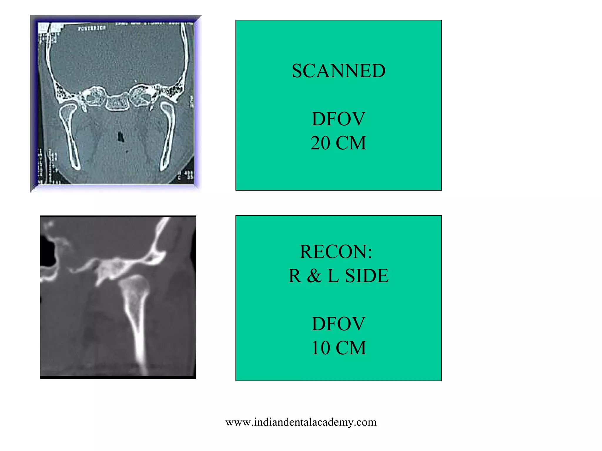 SCANNED
DFOV
20 CM

RECON:
R & L SIDE
DFOV
10 CM

www.indiandentalacademy.com

 