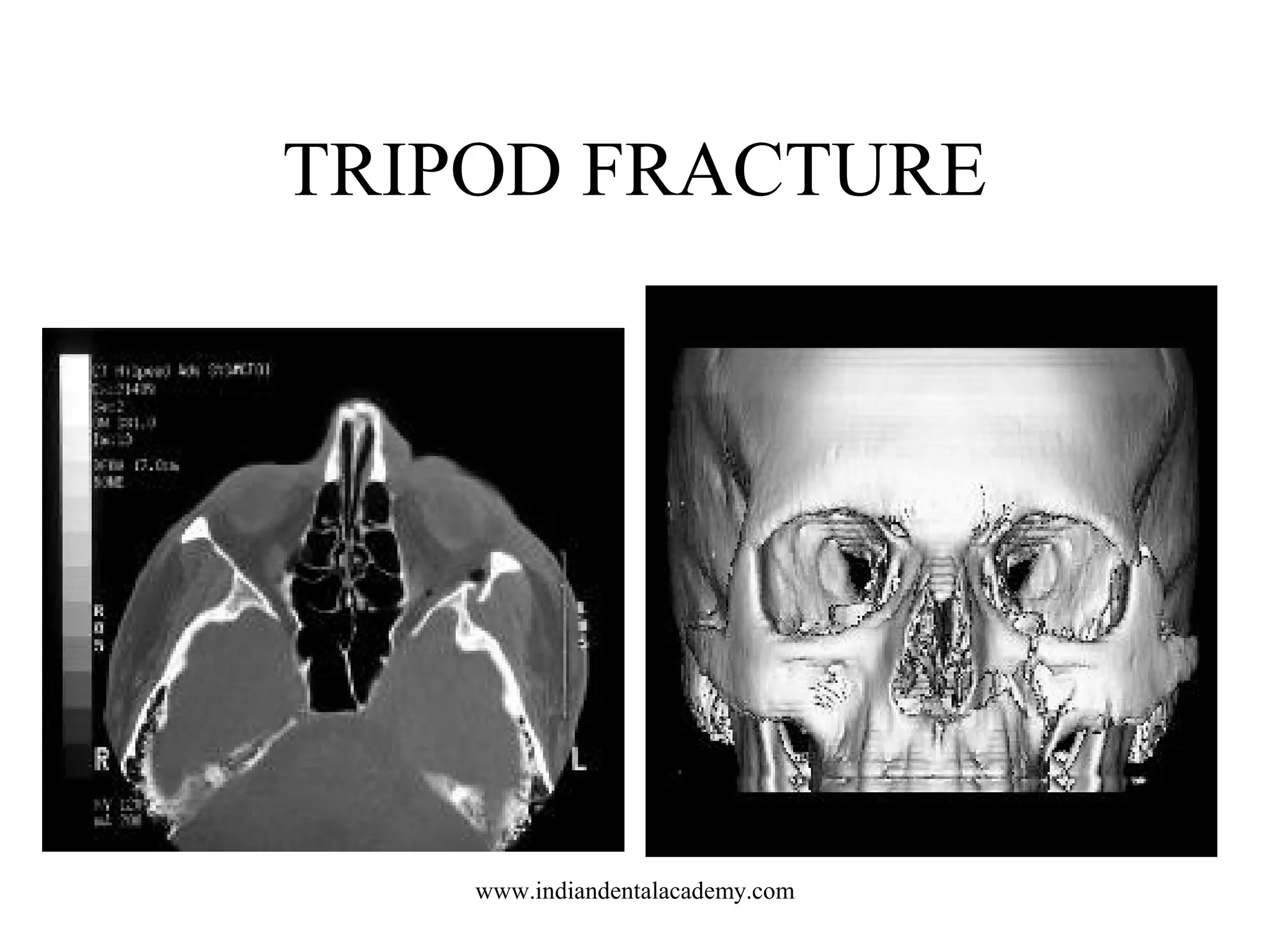TRIPOD FRACTURE

www.indiandentalacademy.com

 