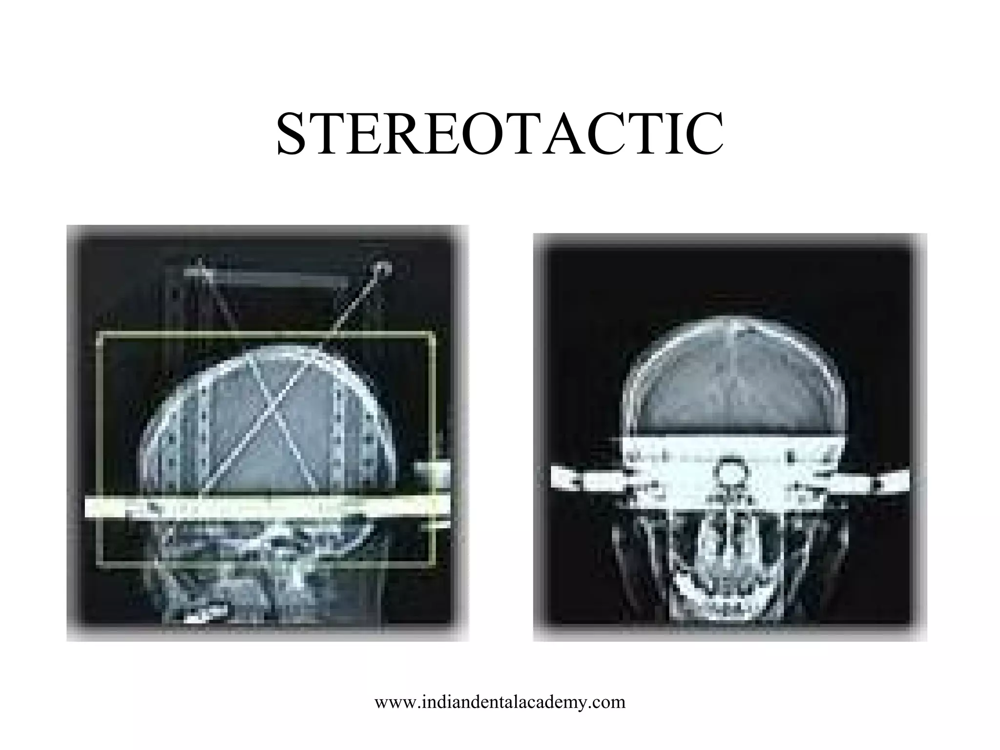 STEREOTACTIC

www.indiandentalacademy.com

 
